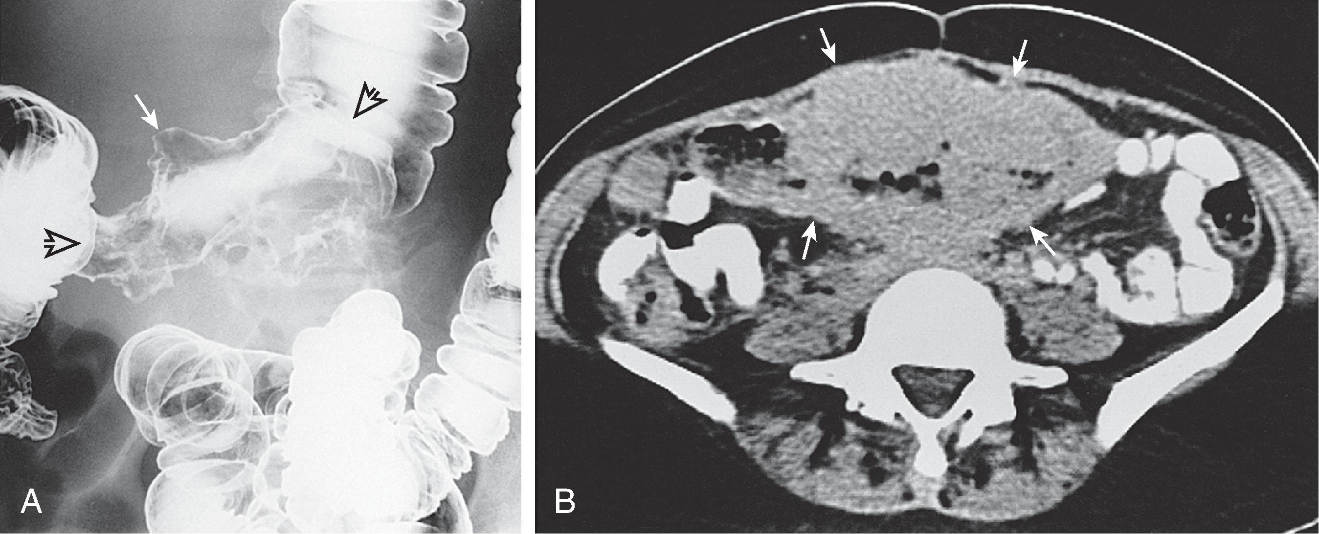 Fig. 44.1, Lymphoma of the transverse colon. (A) Spot image from a double-contrast barium enema shows a long (limits denoted by open arrows ) concentric lesion in the transverse colon, with an irregular contour. Note protrusion of the contour superiorly outside the expected lumen of the bowel (arrow) ; this finding indicates cavitation of the mass. (B) Computed tomography scan shows a large soft tissue mass (arrows) with lobular thickening of the walls of the transverse colon.