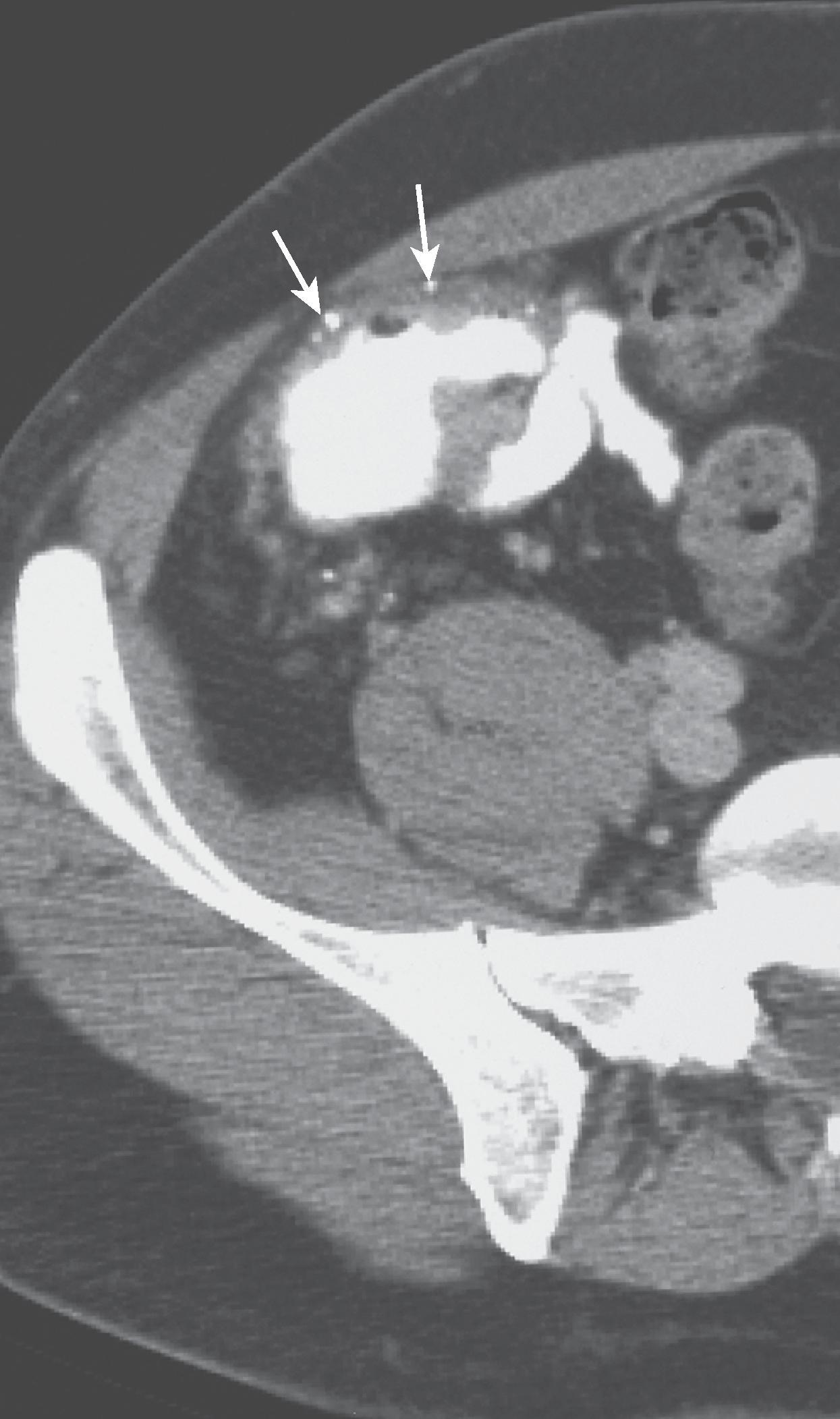 Fig. 44.2, Hemangioma of the colon. Computed tomography scan shows lobulated thickening of the circumference of the wall of the cecum with numerous calcified phleboliths (arrows) in the subserosa.