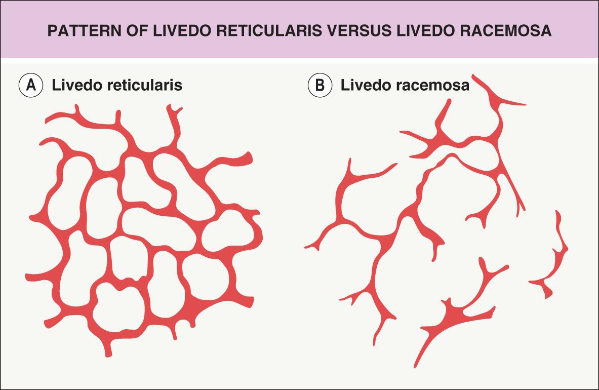 Fig. 106.2, Pattern of livedo reticularis (A) versus livedo racemosa (B).