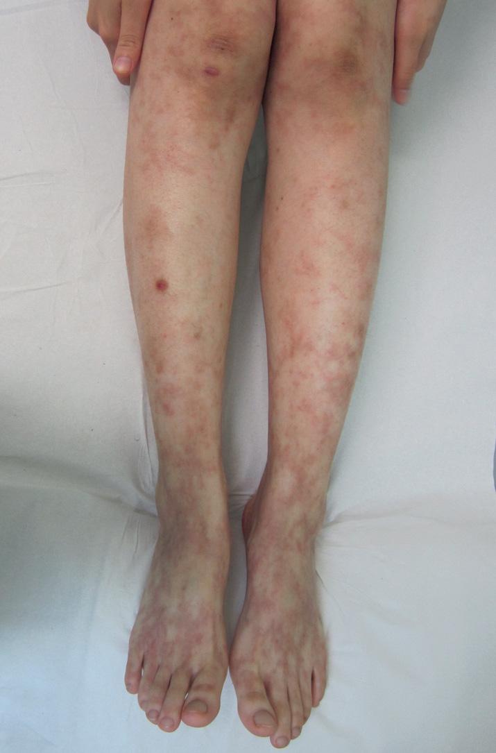 Fig. 106.3, Livedo racemosa in a patient with lymphocytic thrombophilic arteritis.