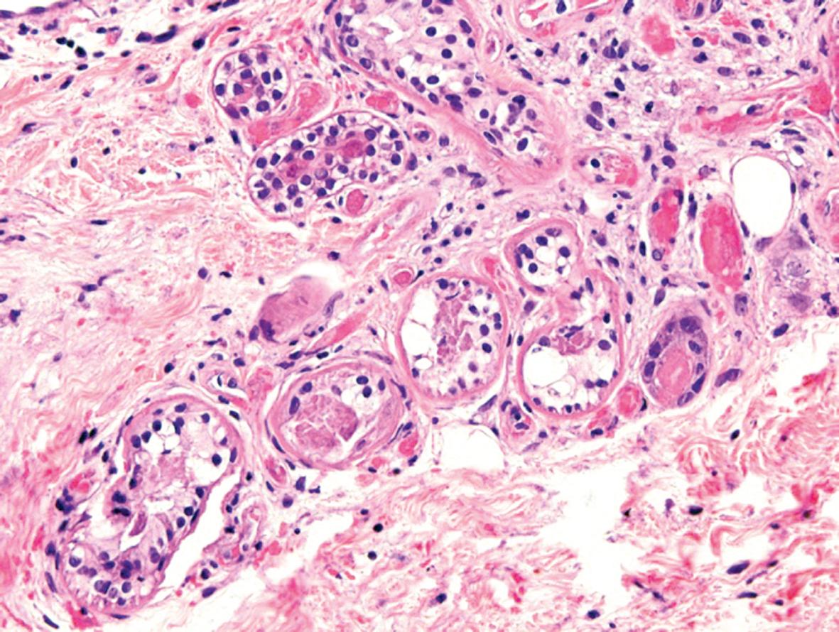 Fig. 33.4, Bulla due to prolonged immobilization (“coma blister”) – histologic features.