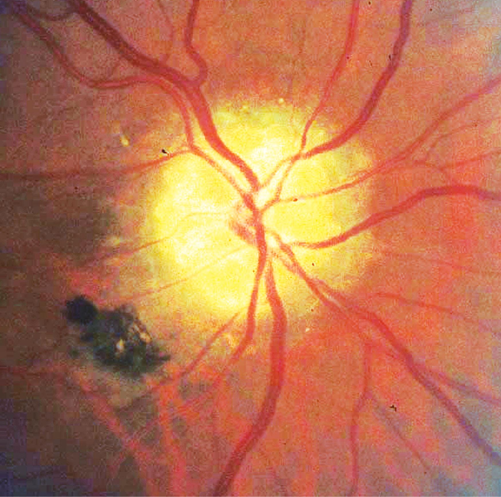 Fig. 55.1, Surface optic disc drusen demonstrating the typical appearance of a “lumpy, bumpy” disc surface with visible irregular deposits on the surface of the optic disc.