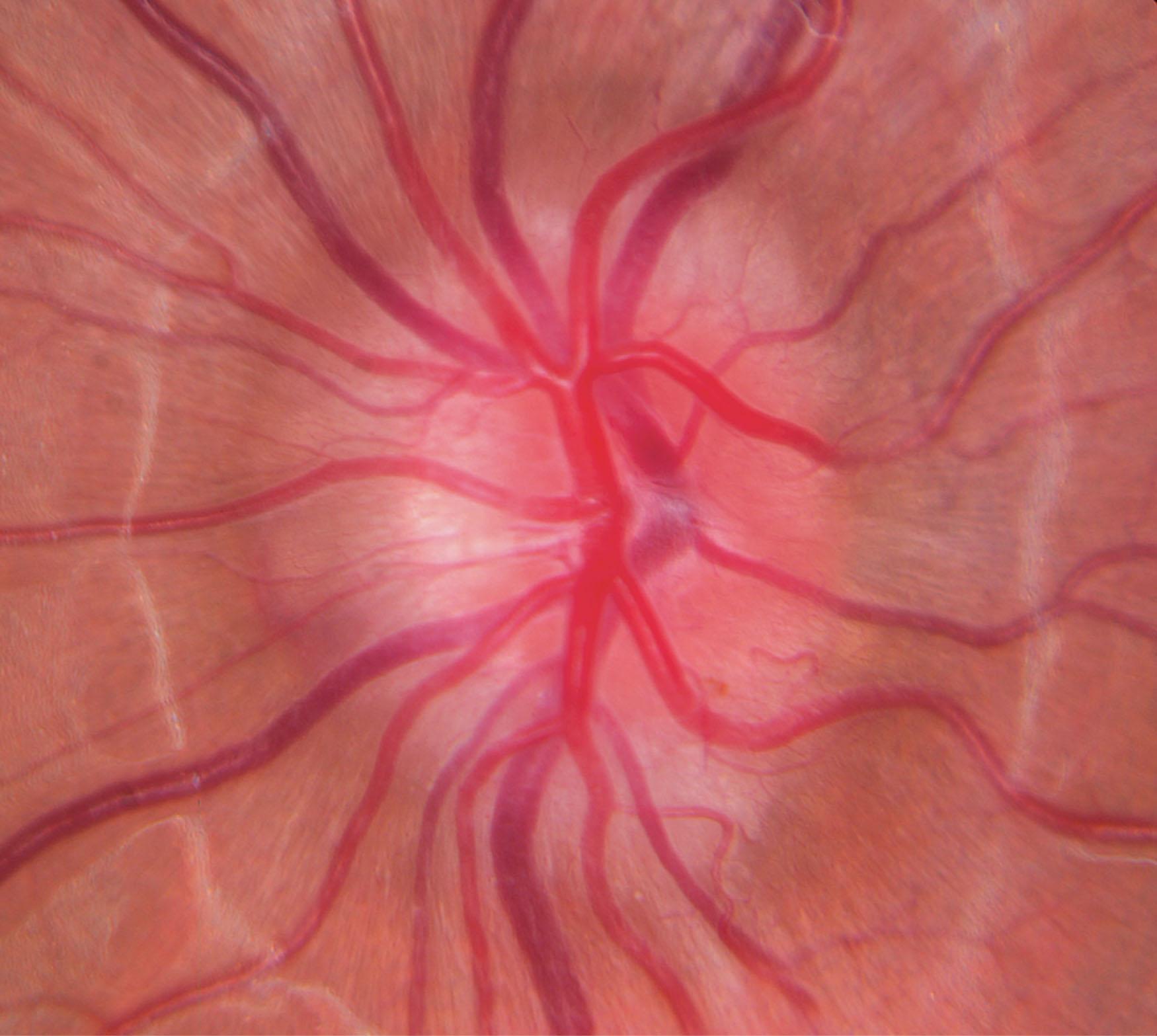 Fig. 55.2, Buried optic disc drusen cause optic nerve elevation and blurring of the optic disc margins.