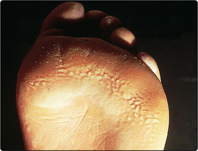 Fig. 28.1, Pitted keratolysis, due to overgrowth of resident microorganisms.