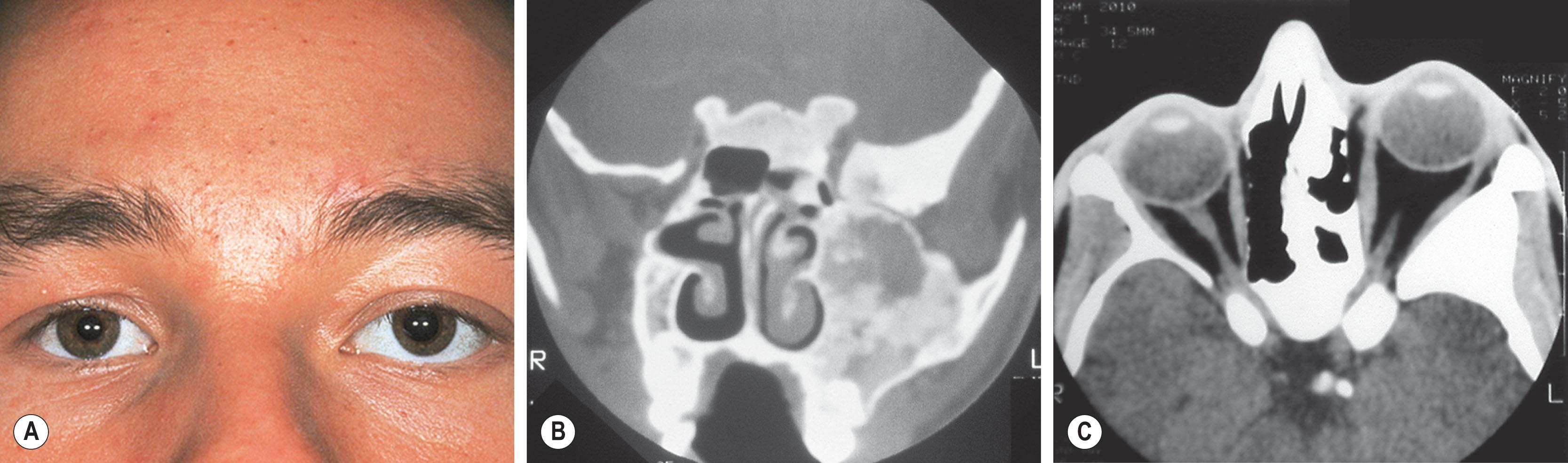 Fig. 23.1, (A) This 16-year-old with fibrous dysplasia presented with progressive facial distortion and compressive left optic neuropathy. (B) Computed tomography (CT) scan shows cystic fibrous dysplasia involving the orbital apex. (C) Axial CT scan shows optic canal involvement which was surgically decompressed.