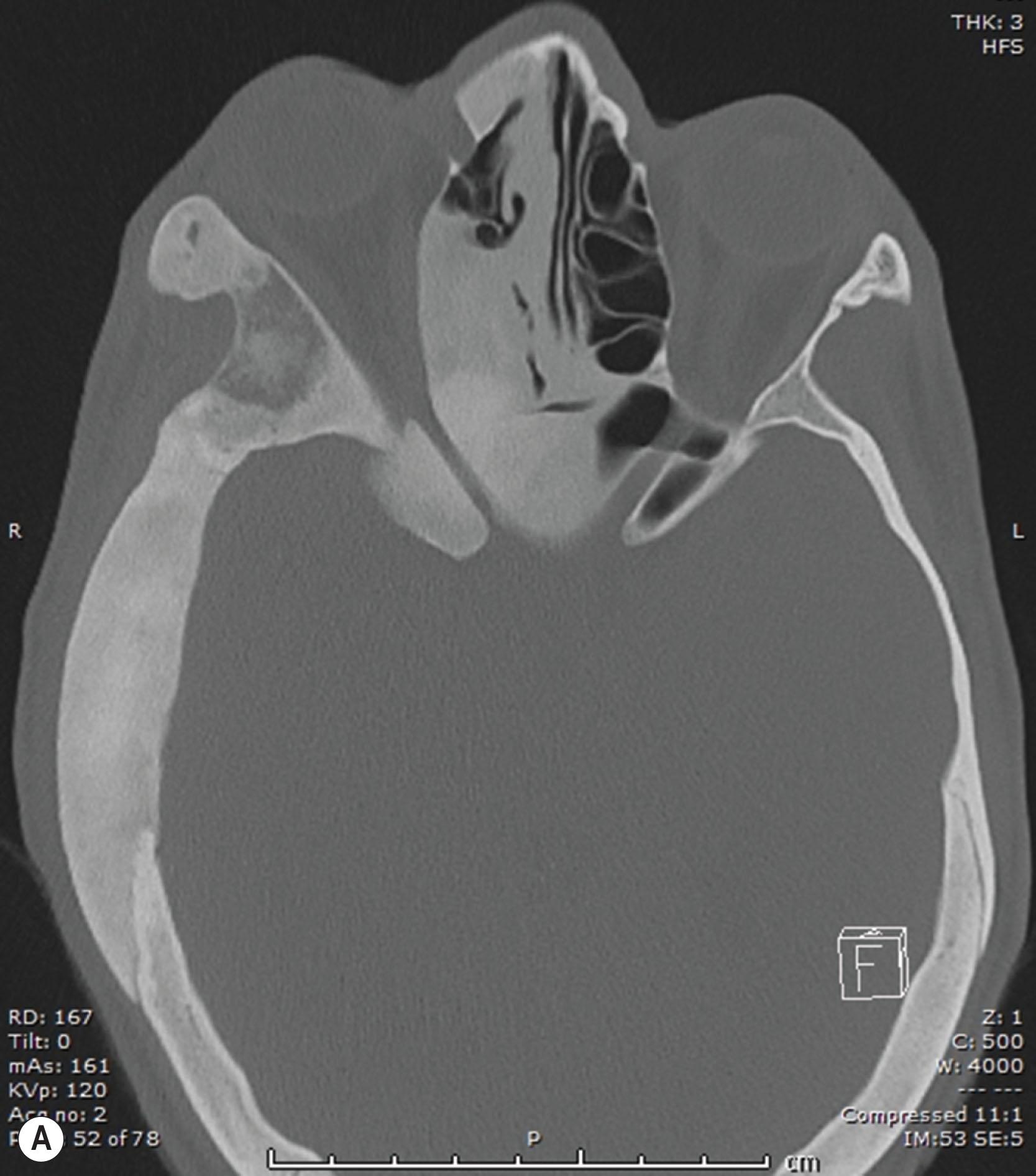 Fig. 23.2, Polyostotic fibrous dysplasia/McCune–Albright syndrome. Axial (A) and coronal (B) CT showing predominantly right-sided craniofacial polyostotic disease with sphenoid involvement but minimal optic canal narrowing and preserved optic nerve function. MRI shows heterogeneous iso- and hyperintensity on fat-suppressed T2 (C) and less heterogeneous iso- and hypointensity on T1 sequences (not shown). Patient of the Royal Children’s Hospital, Melbourne.