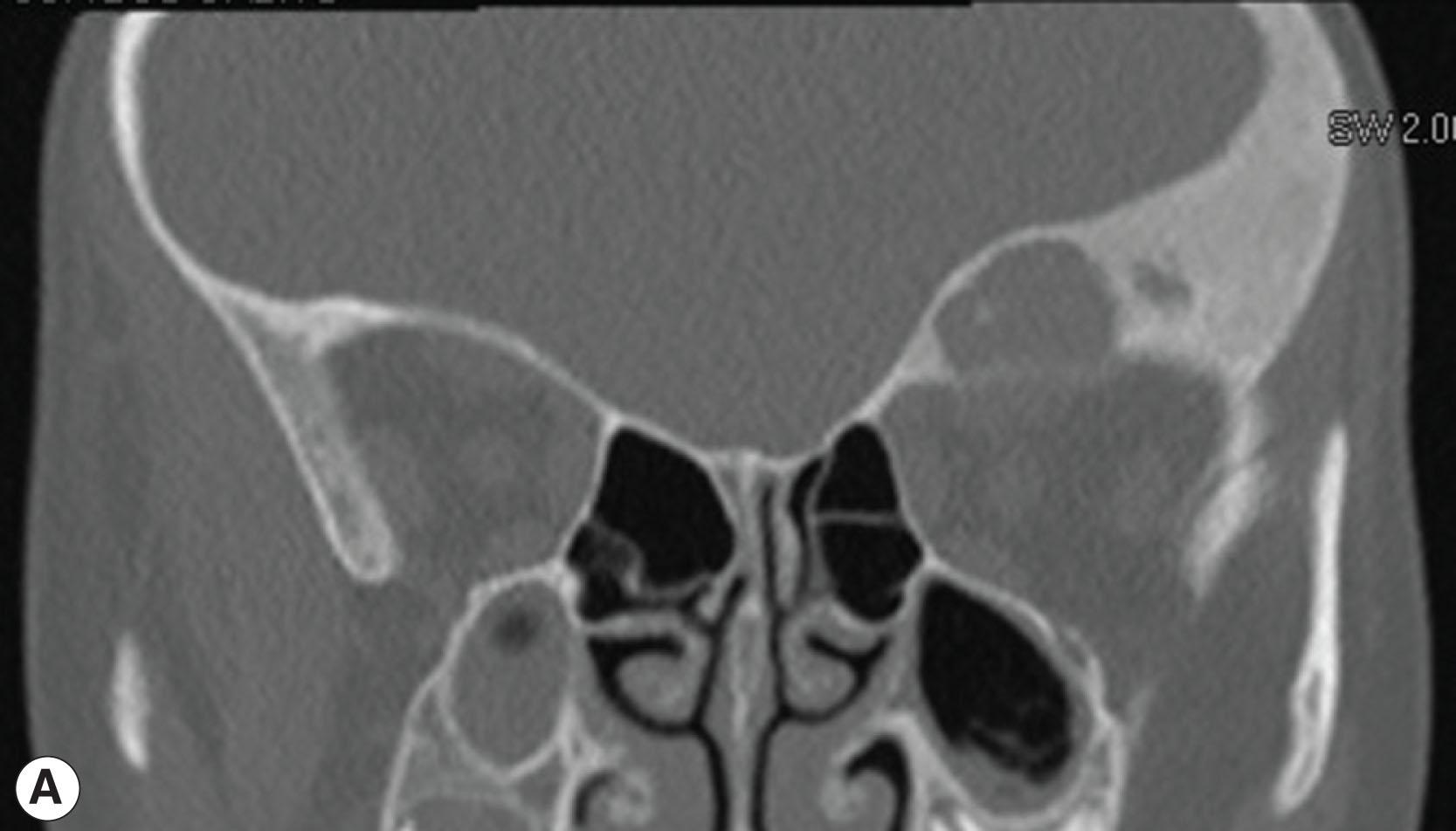 Fig. 23.3, This patient with long-standing monostotic left frontal bone fibrous dysplasia presented with cystic change and recent hemorrhage. Coronal CT shows a significant lytic component medial to sclerotic bone (A,B), and coronal T2 fat-suppressed MRI (C) shows internal signal heterogeneity consistent with subacute hemorrhage.