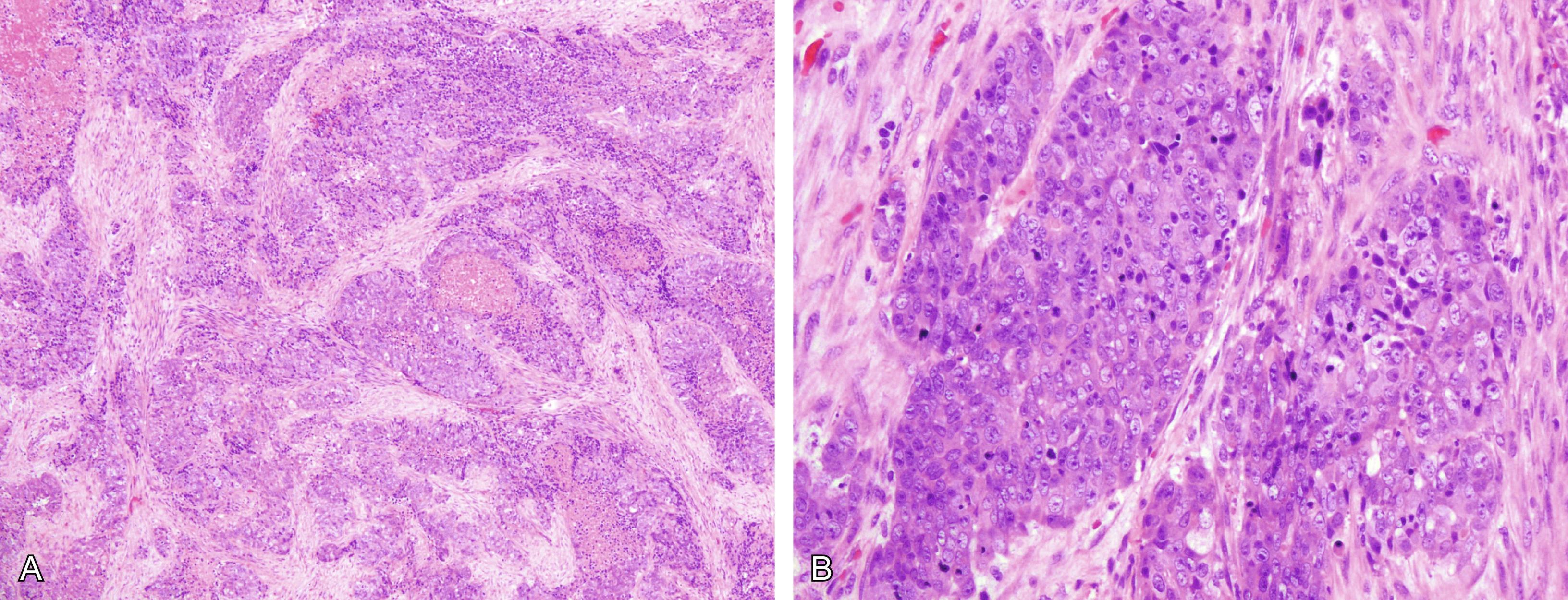 Fig. 13.1, (A) Large-cell neuroendocrine carcinoma with infiltrating nested pattern and foci of central necrosis. (B) Large-cell neuroendocrine carcinoma with large polygonal cells, abundant cytoplasm and prominent nucleoli.