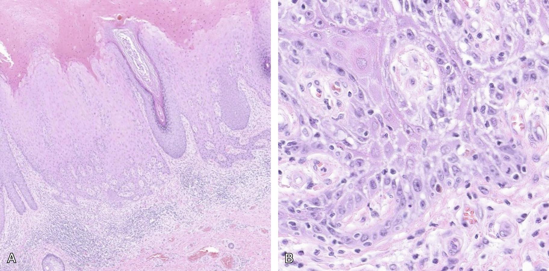 Fig. 20.1, dVIN with acanthosis and elongation and fusion of the rete ridges (A) demonstrating basal and parabasal cytologic atypia (B).