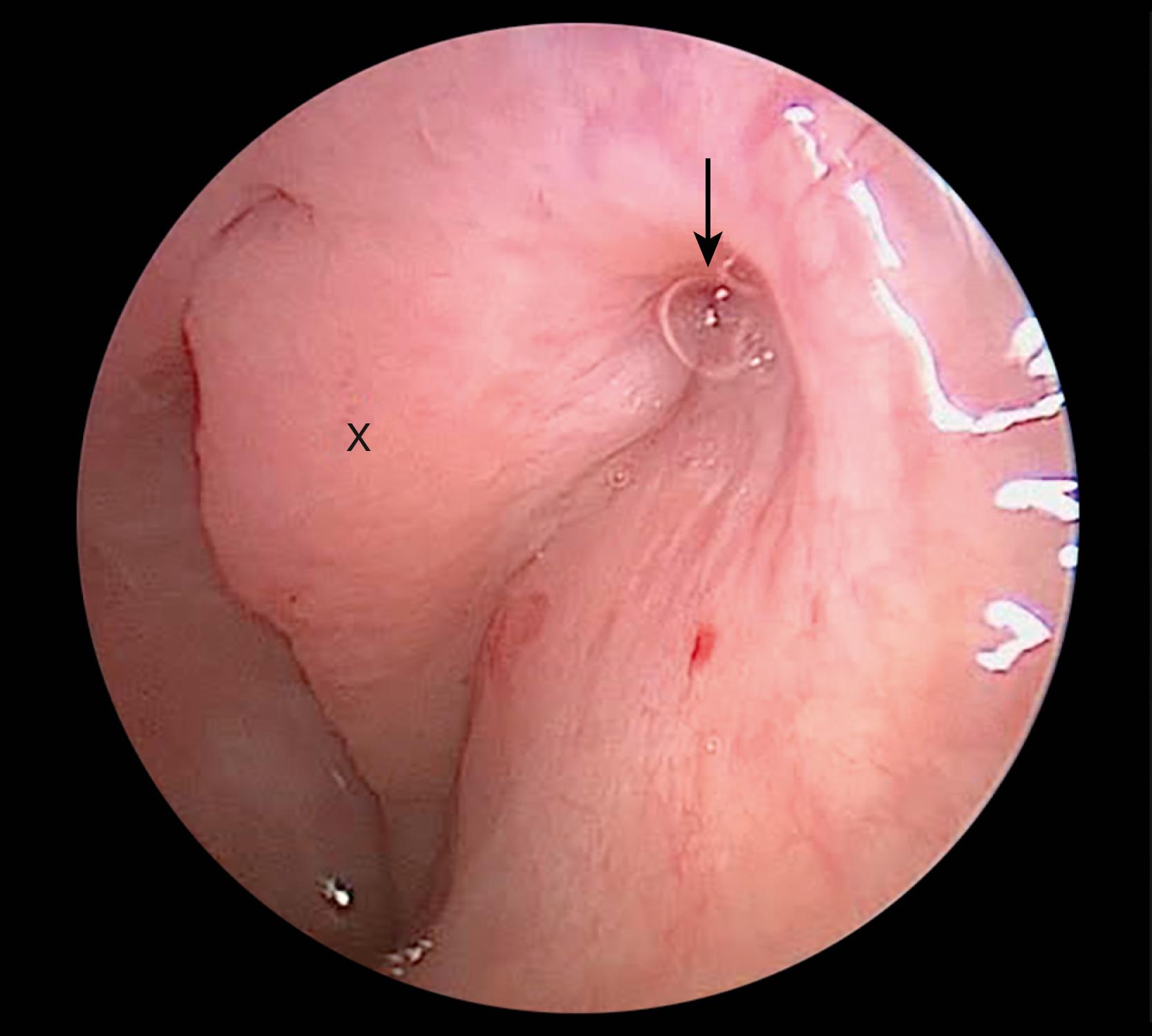 Fig. 129.1, Endoscopic view of the nasopharyngeal opening of a left eustachian tube showing significant peritubal inflammation. X, posterior cushion lined with hypertrophic mucosa. Arrow, collapsed lumen of the eustachian tube with secretions.