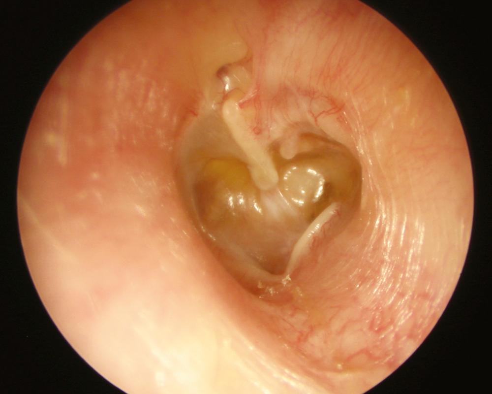 Fig. 129.2, Severe atelectasis with a natural type II/III tympanoplasty. Ventilation of the middle ear aims to lateralize the tympanic membrane off the promontory and ossicles.