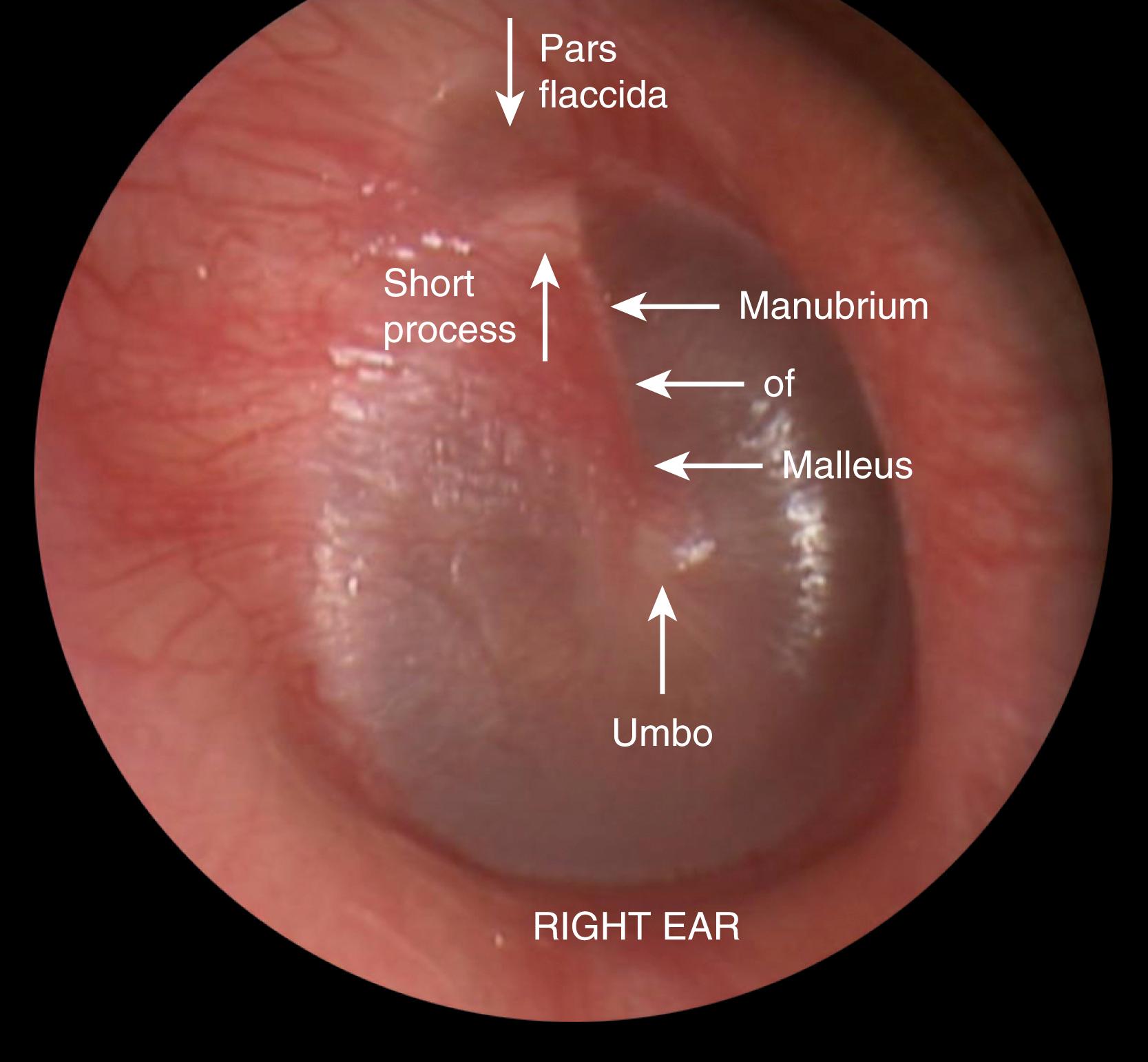 Fig. 203.1, Tympanic membrane landmarks.