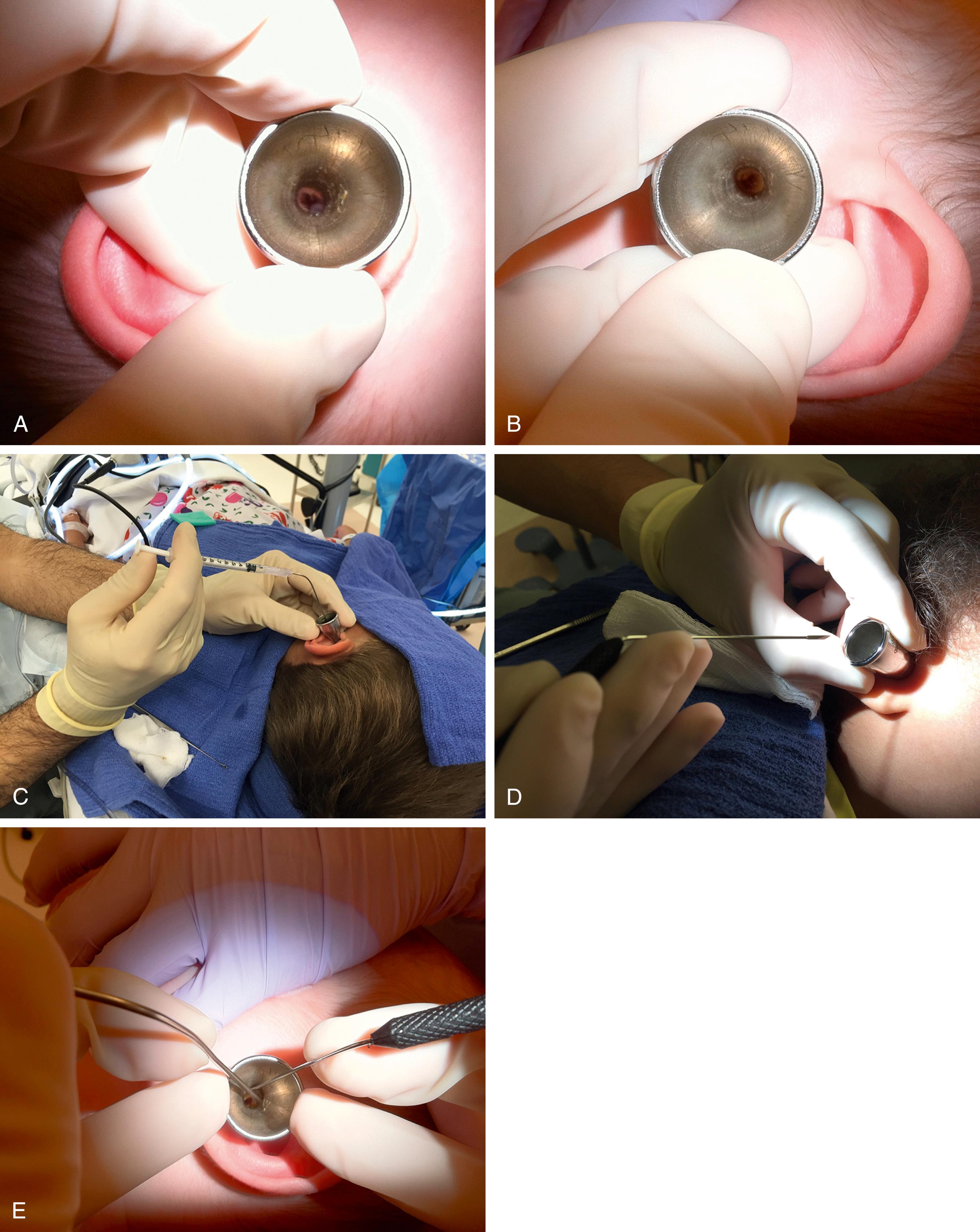 Fig. 203.2, A, The speculum is held as shown for the right ear for a right-handed surgeon; the third finger is placed in the concha to retract the pinna in the posterosuperior direction so that the ear canal can be straightened with one hand. B, The speculum is held as shown for the left ear for a right-handed surgeon; the third finger is passed inferior to the speculum and placed in the concha to retract the pinna in the posterosuperior direction so that the ear canal can be straightened with one hand. C, If a trap with suction is not available, tympanocentesis may be performed with a spinal needle and a tuberculin syringe. D, To handle the myringotomy knife, the thumb and index finger hold the handle while the third finger stabilizes the shaft of the knife, freeing up the fourth finger to be anchored on the speculum edge and the fifth finger to be anchored on the head if possible. E, Bimanual handling of the speculum, myringotomy knife, and suction. Instruments are held as described earlier, both fourth fingers anchored on the speculum and both fifth fingers anchored on the head for stabilization.