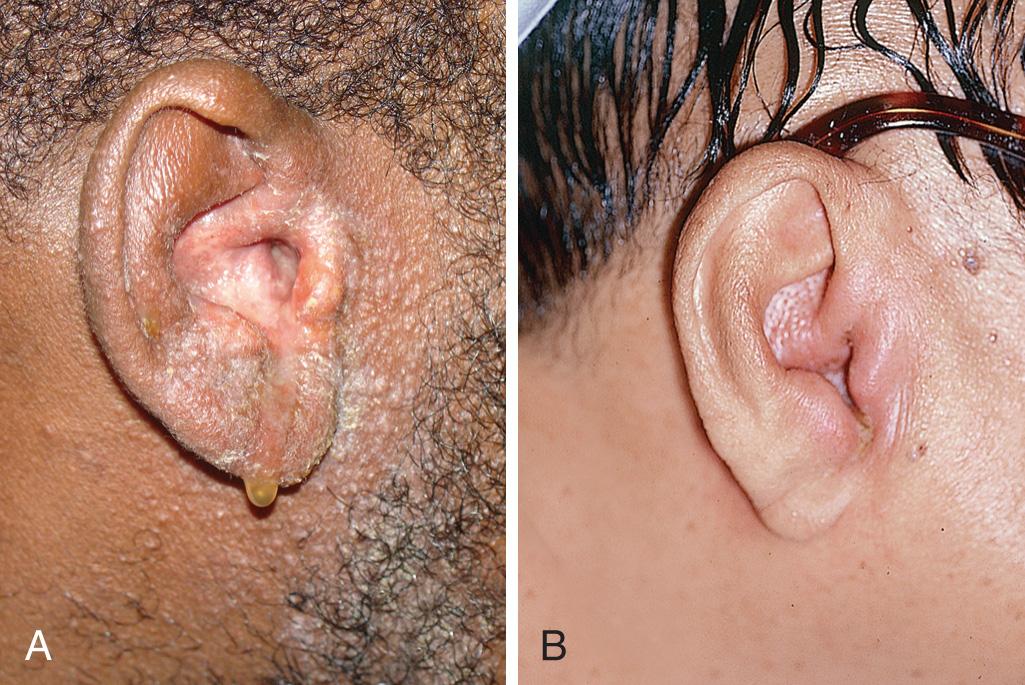 Figure 63.18, A, Extensive contact dermatitis from the use of neomycin-containing ear drops. B, Malignant otitis externa in a diabetic patient developed after the patient manually removed cerumen with a cotton swab and a pencil, but it may develop without manipulation of the canal.