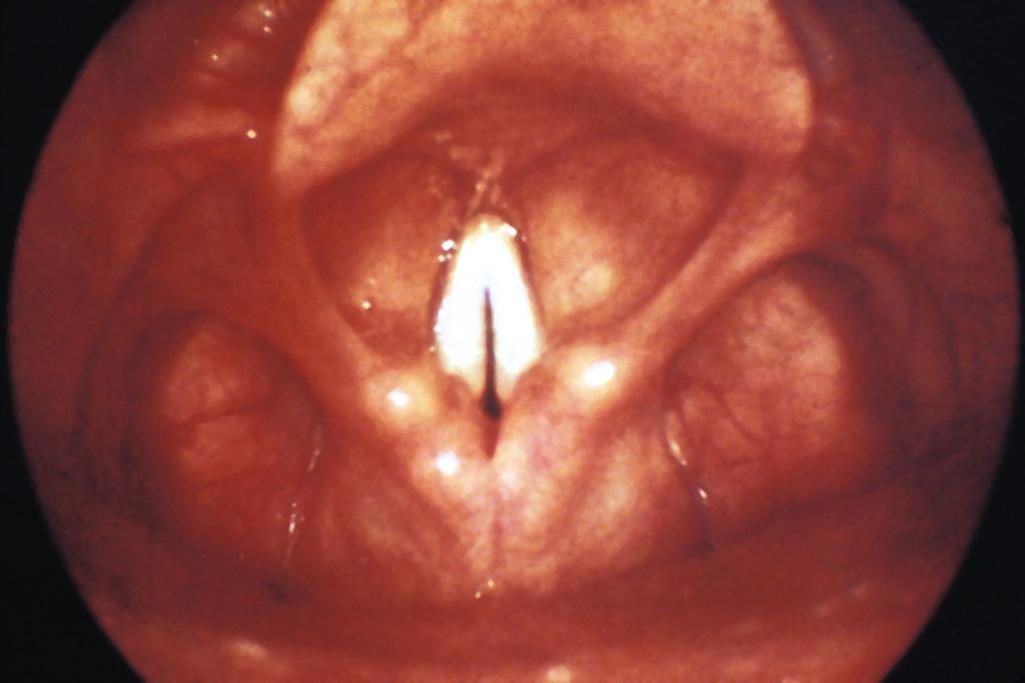 Figure 63.5, Instruct the patient to say “eeeeee” in a high-pitched voice during the examination. This lifts the epiglottis out of your field of view and allows excellent visualization of the glottis. In this picture the vocal cords close with phonation. A paralyzed cord is easily discerned from one that is normal.