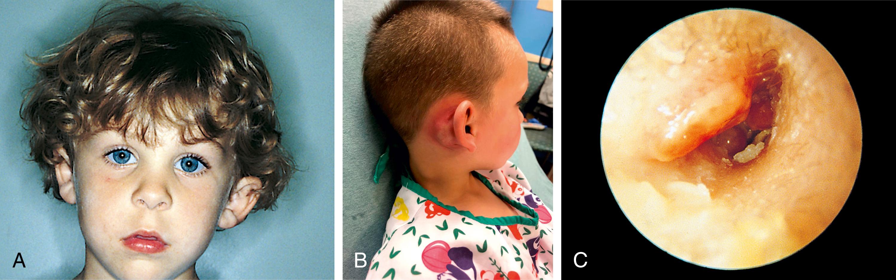 Fig. 24.10, Mastoiditis. (A) This frontal photograph clearly shows the left auricle displaced anteriorly and inferiorly. (B) In another patient, viewed from the side, erythema can be appreciated over the mastoid process. (C) On otoscopy, erythema and edema of the canal wall are evident and the posterosuperior portion of the canal wall sags inferiorly.