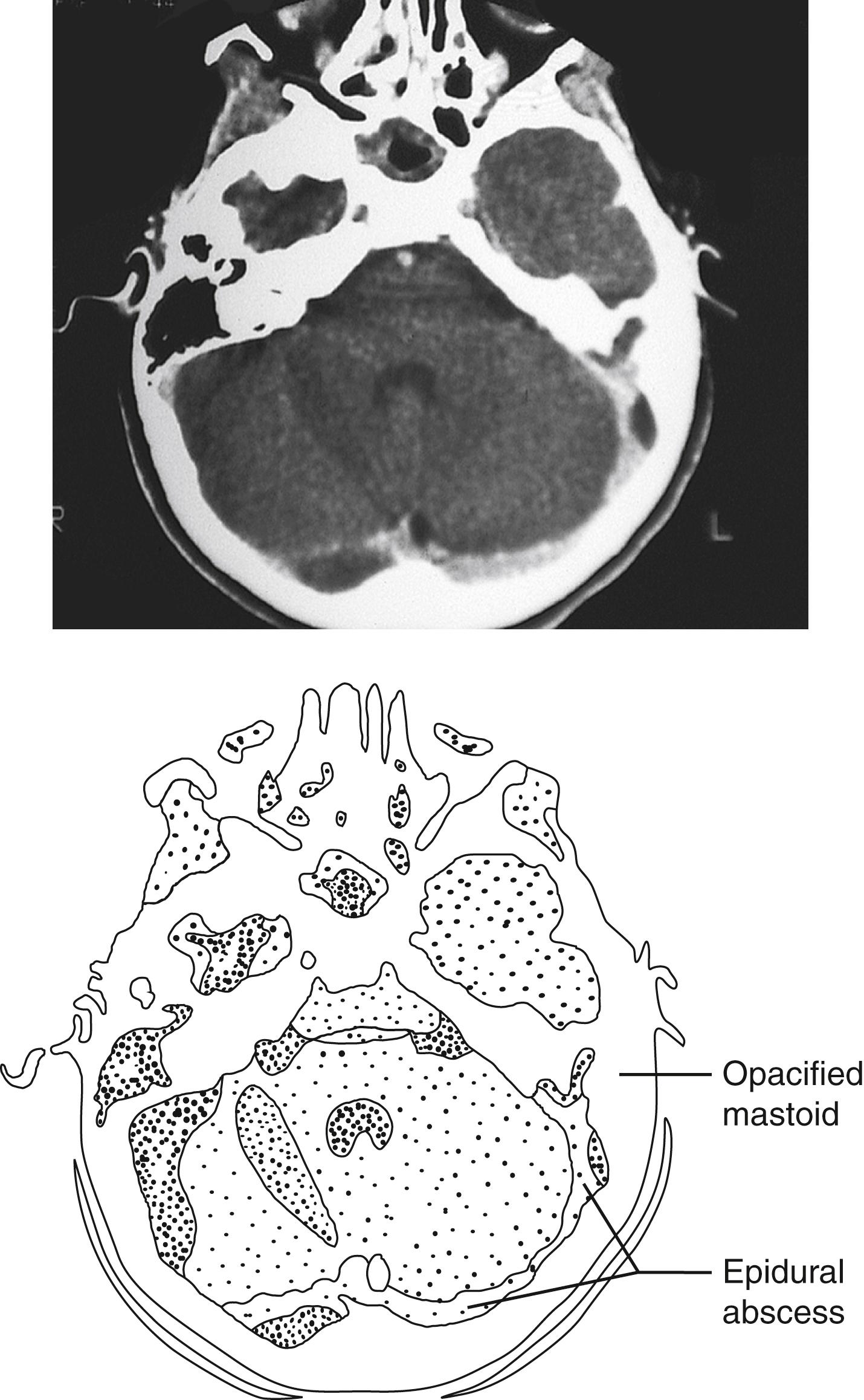 Fig. 24.11, Mastoiditis. The computed tomography (CT) image shows acute left-sided mastoiditis with the complication of an associated epidural abscess delineated in the diagram.