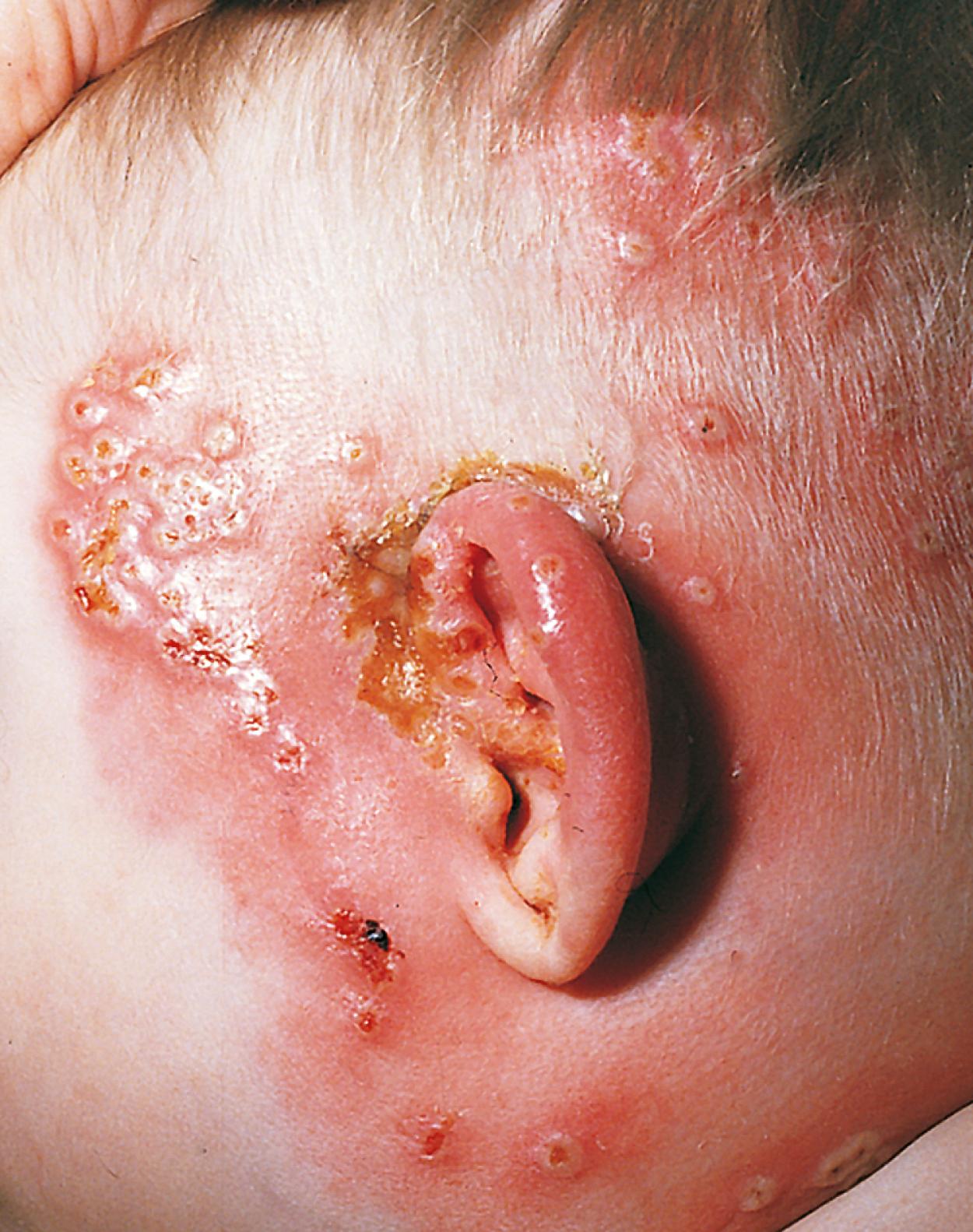 Fig. 24.12, Periauricular and auricular cellulitis. This infant had mild postauricular seborrhea and developed varicella. The vesicular varicella lesions that clustered at sites of prior skin irritation became secondarily infected with group A β-streptococci, resulting in cellulitis with intense erythema, edema, and tenderness of the auricle and periauricular tissues. In this case, the external canal was normal.