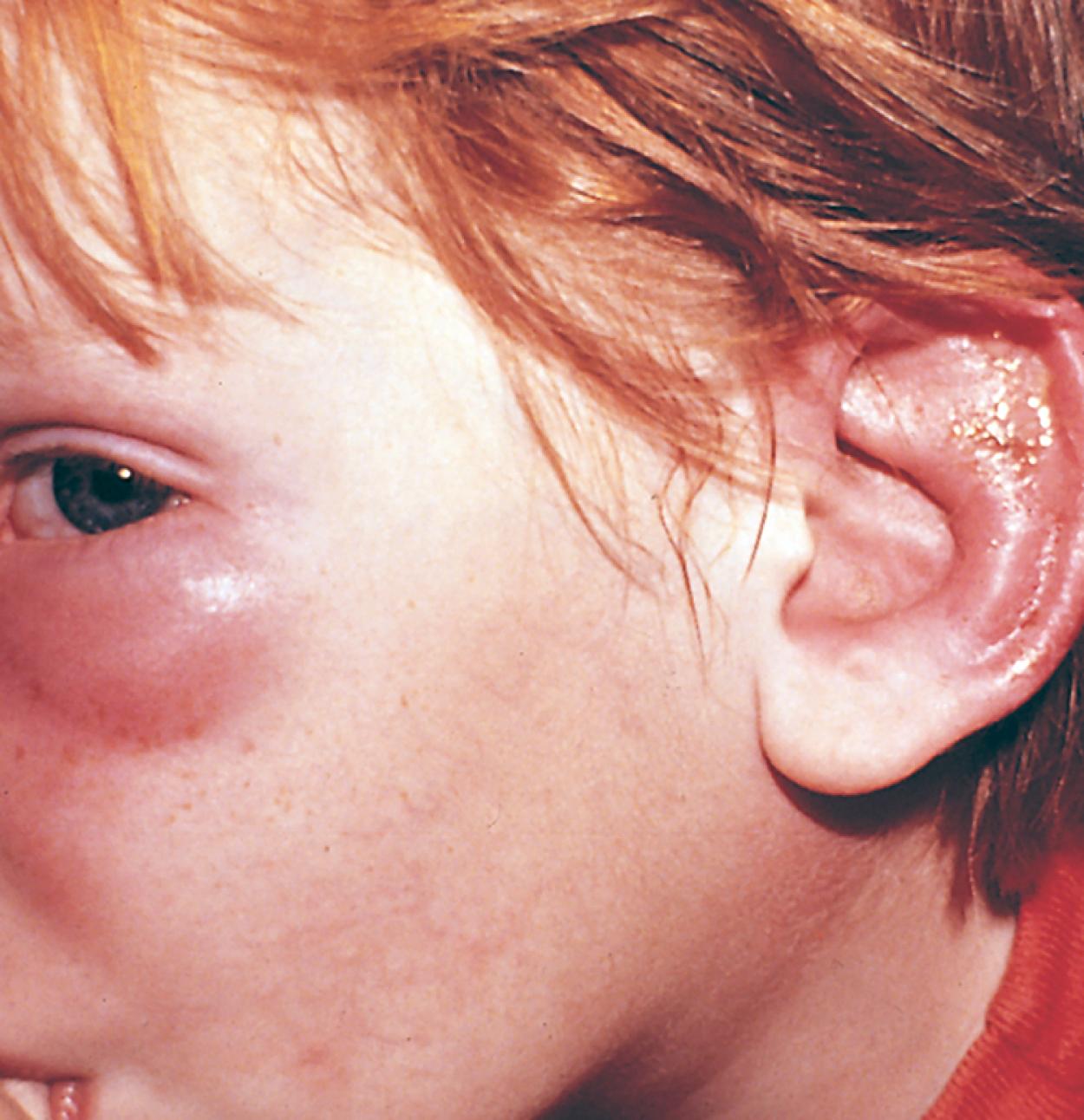 Fig. 24.14, Angioedema. This youngster had pruritic, nonpainful, nontender erythema, and swelling of his ear and infraorbital region. Close examination of the latter revealed the punctum of an insect bite. Another punctum on his ear was obscured by crusting following scratching.