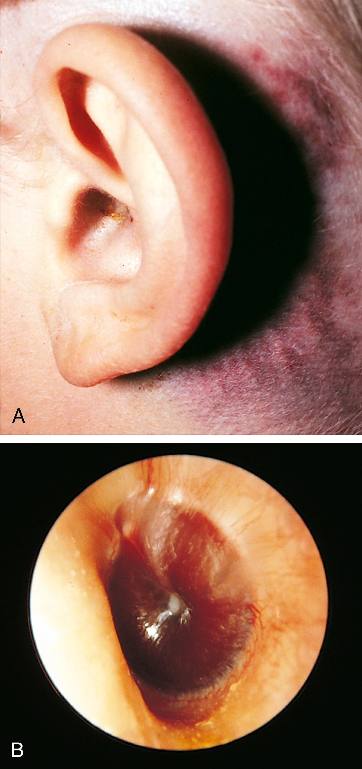 Fig. 24.15, Basilar skull fracture. (A) The presence of a basilar skull fracture involving the temporal bone is often signaled by postauricular ecchymotic discoloration, termed the Battle sign. (B) The force of the blow may also cause tearing of the ear canal or, as shown here, middle ear hemorrhage with hemotympanum. Depending on the timing of examination, this may appear red or blue.