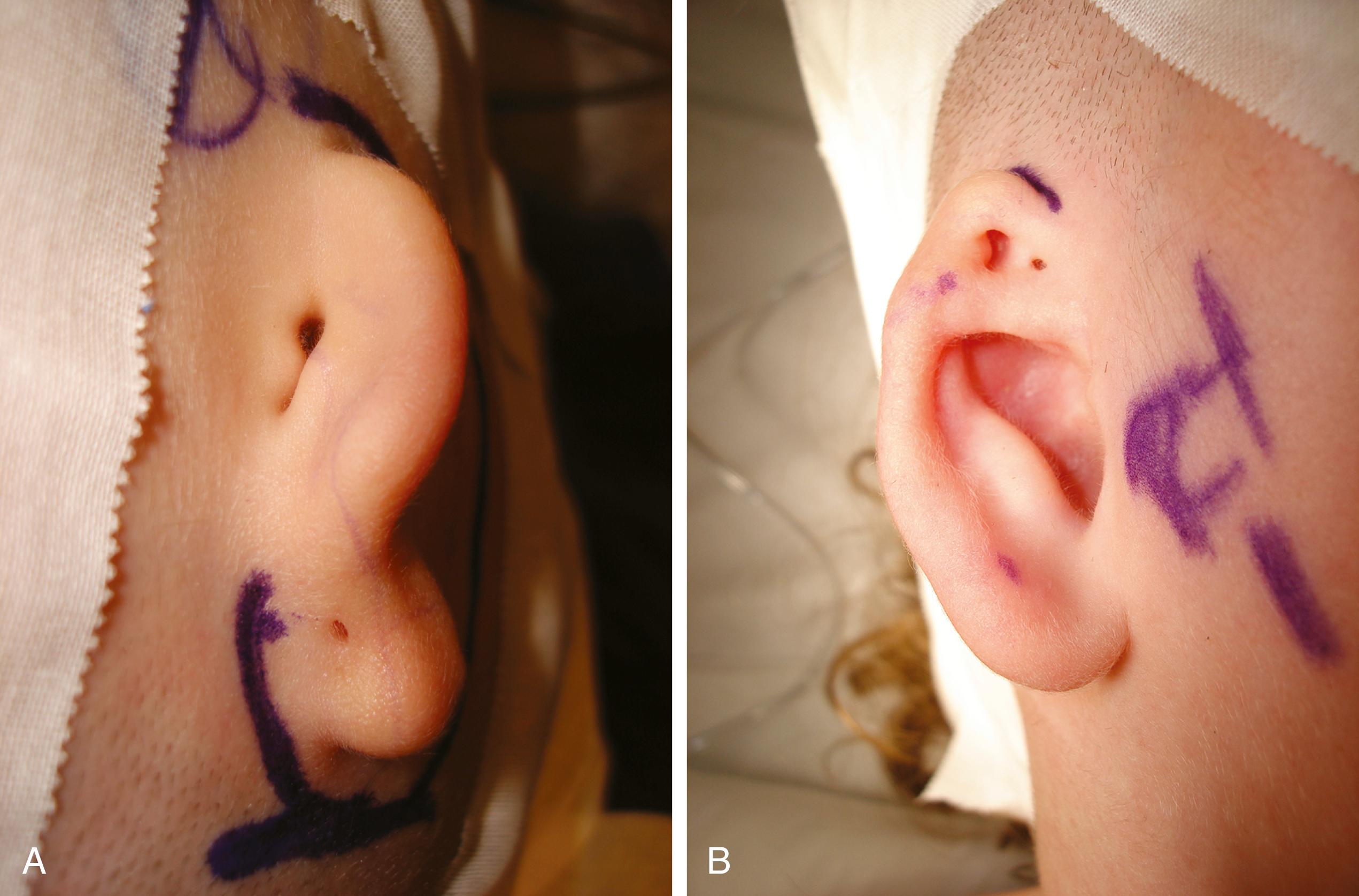 Fig. 24.16, (A) Grade 3 microtia and congenital aural atresia of the right external ear. In this otherwise normal child, the pinna failed to develop properly and the external canal was atretic. Audiometric testing revealed a 60-dB hearing loss. (B) Grade 2 microtia. Note deficiency of superior portion of auricle. Such isolated deformities stem from abnormal development of the first and second branchial arches.