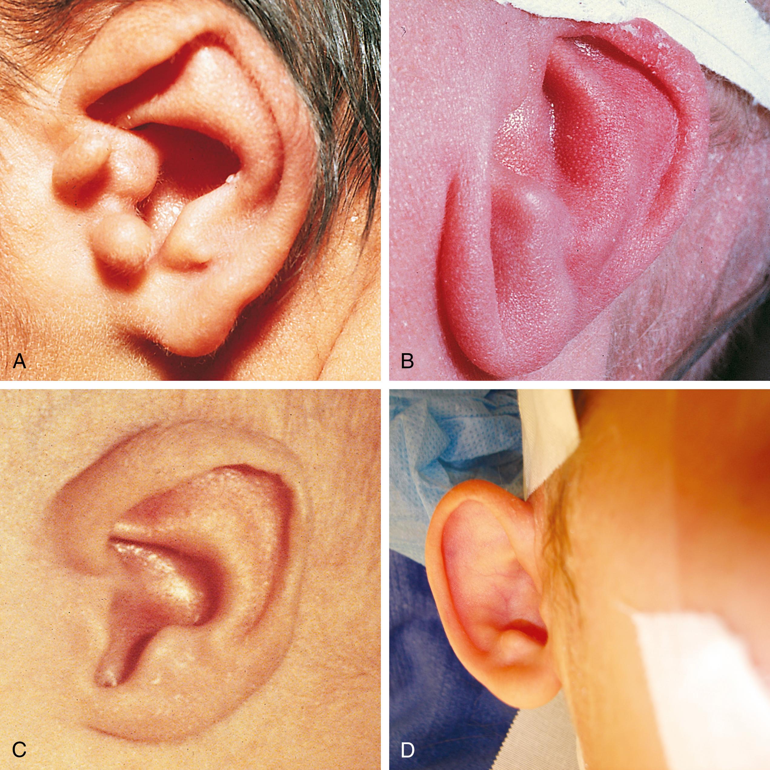 Fig. 24.17, Minor congenital auricular deformities. (A) In this infant, the superior portion of the helix is folded over, obscuring the triangular fossa; the antihelix is sharply angulated; and there are three preauricular skin tags. (B) This neonate with orofaciodigital and Turner syndromes has a simple helix and a redundant folded lobule. The ear is low set and posteriorly rotated, and the antitragus is anteriorly displaced. (C) This infant with Rubinstein-Taybi syndrome has an exaggerated elongated intertragal notch. (D) Prominent ear in an otherwise normal child. The auricular cartilage is abnormally contoured, making the ear protrude forward.