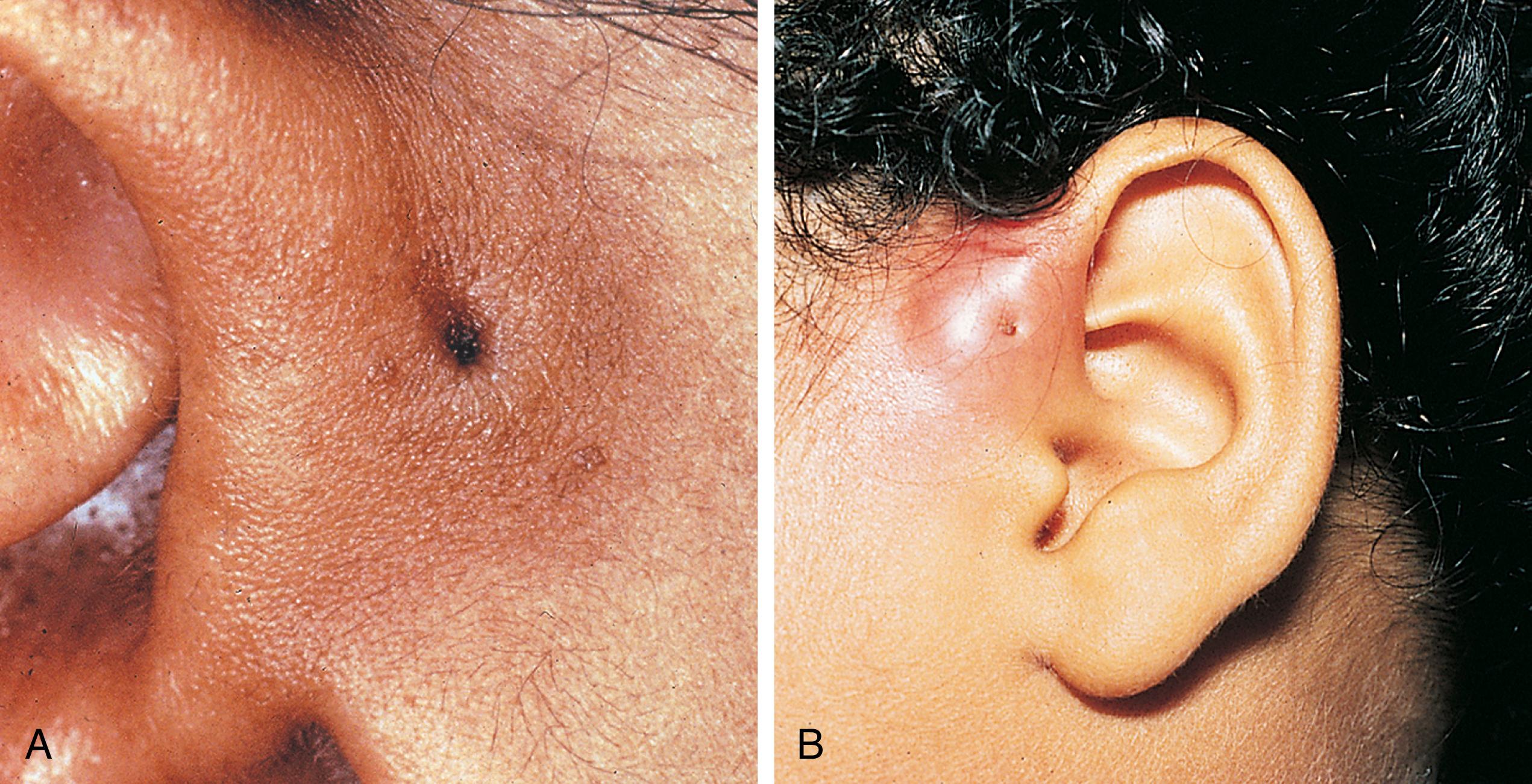 Fig. 24.18, Preauricular sinuses. (A) These congenital remnants are located anterior to the pinna and have an overlying surface dimple. (B) In this child, the sinus has become infected, forming an abscess.