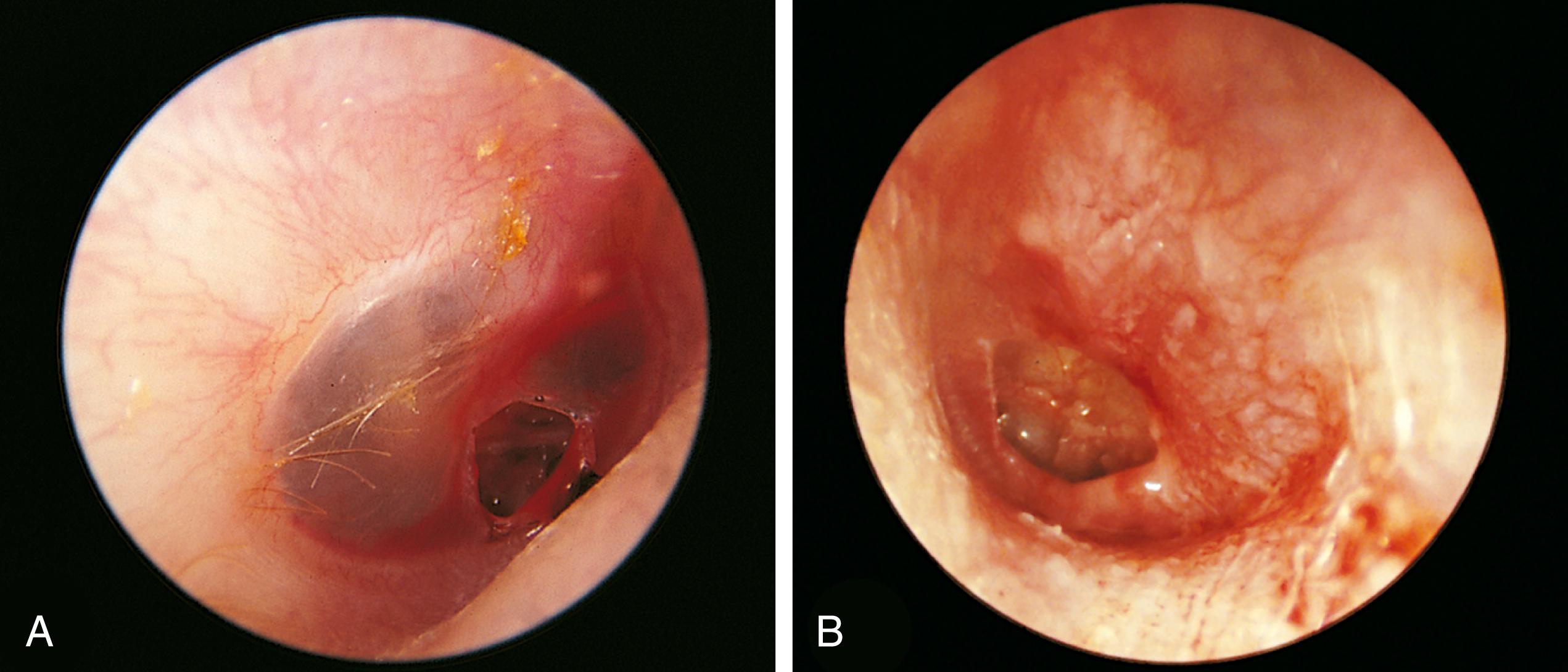 Fig. 24.20, Traumatic perforations of the tympanic membrane. (A) This 8-year-old boy’s tympanic membrane was perforated by a forceful slap on the ear. (B) Even more severe damage with thickening and hemorrhage is seen in this victim of a blast injury caused by an explosion.