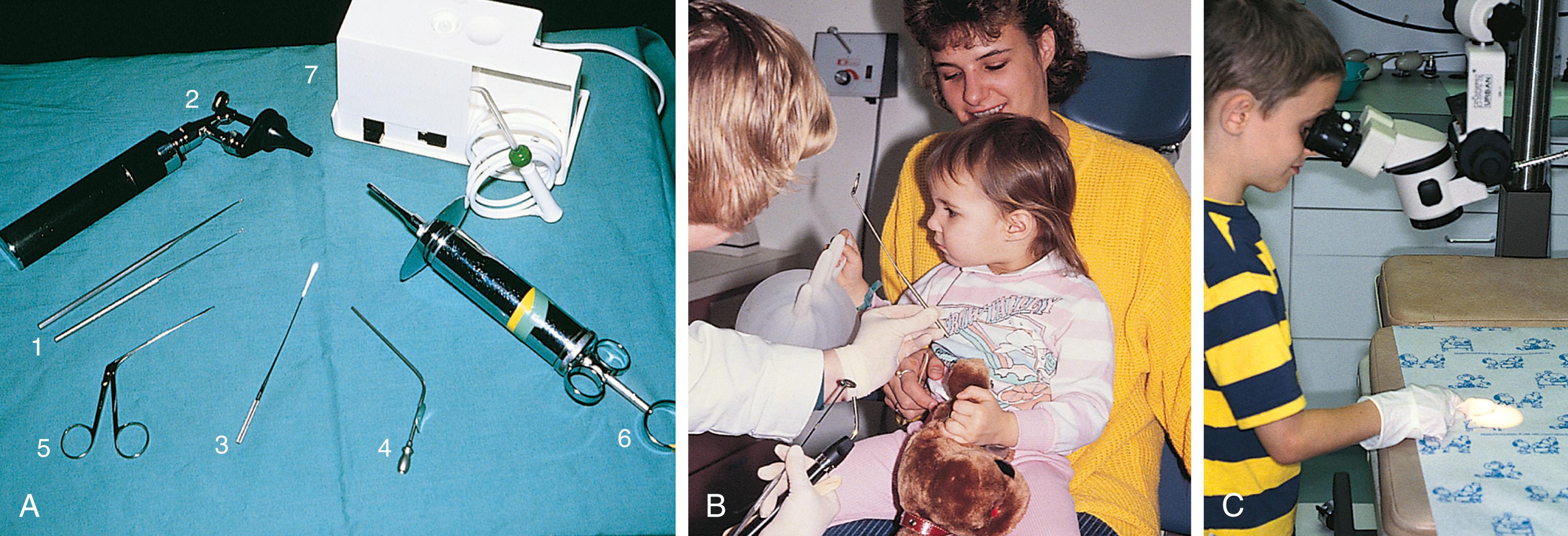 Fig. 24.3, (A) Equipment for cleaning the external auditory canal. The curette (1) is the implement most commonly used to remove cerumen. Use of a surgical otoscope head (2) makes the process considerably easier. Additional implements include cotton wicks (3) and a suction tip (4) for removal of discharge or moist wax, alligator forceps (5) for removing foreign bodies, and an ear syringe (6) and motorized irrigation apparatus (7) for removing firm objects or impacted cerumen. Lavage is contraindicated when there is a possible perforation of the tympanic membrane. If the motorized apparatus is used for irrigation, it must be kept on the lowest power setting to avoid traumatizing the eardrum. (B) Use of suction is often necessary when there is copious exudate. (C) Allowing the child to look through the examining microscope may help him or her cooperate with the examination.