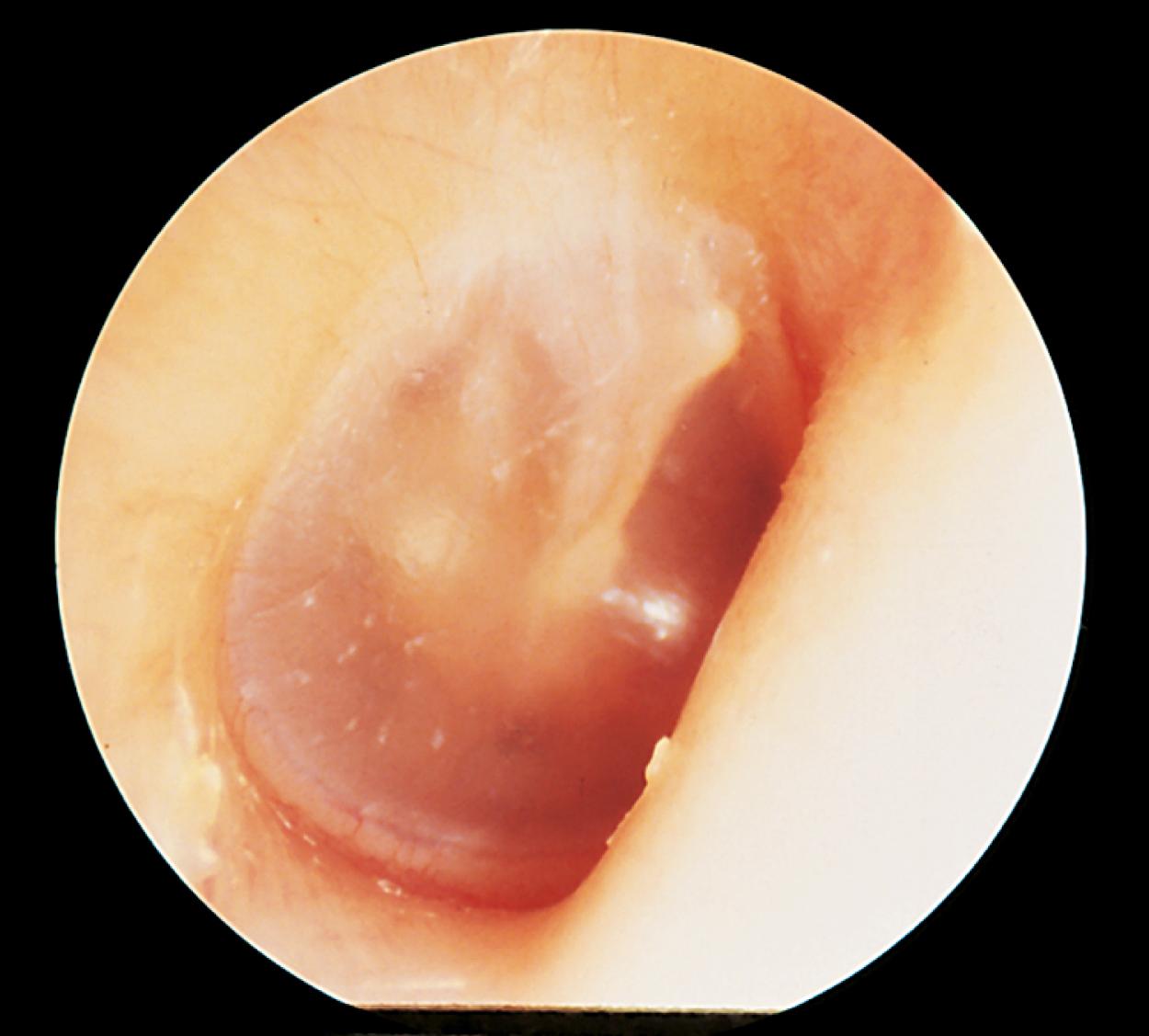 Fig. 24.21, A normal tympanic membrane. The drum is thin and translucent, and the ossicles are readily visualized. It is neutrally positioned with no evidence of bulging or retraction.