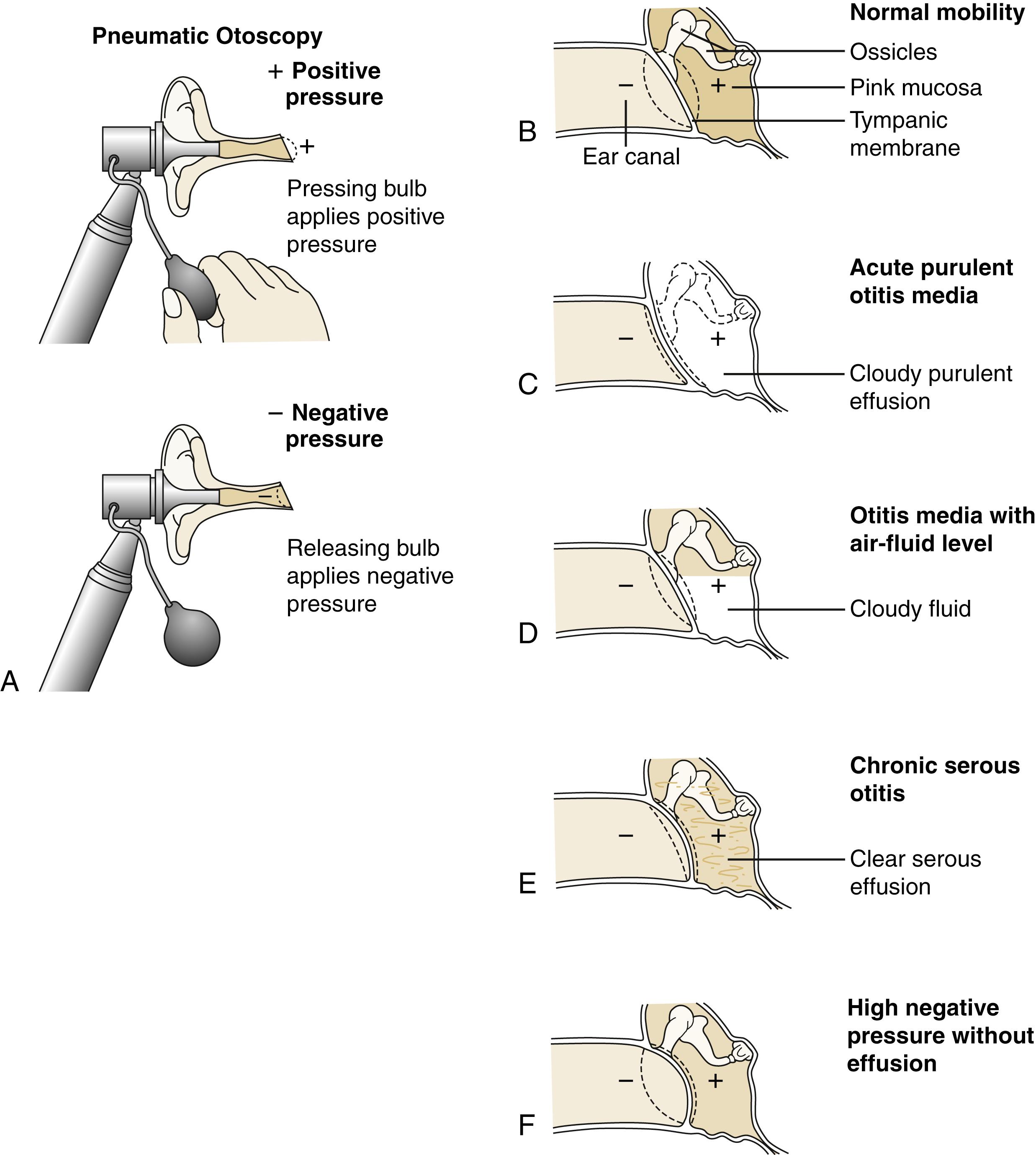 Fig. 24.23, Technique and findings in pneumatic otoscopy. (A) The speculum is inserted into the ear canal to form a tight seal. The bulb is then gently and slowly pressed and released while the mobility of the drum is assessed. Pressing on the bulb applies positive pressure; letting up applies negative pressure. (B) A normal drum moves inward and then back. (C) In cases of acute otitis media, in which the middle ear is filled with purulent material, the drum bulges toward the examiner and moves minimally. (D) In cases of acute otitis media with an air/fluid level, mobility may be nearly normal. In some patients, however, the drum may be retracted, indicating increased negative pressure. If this is the case, mobility on positive pressure may be reduced, whereas movement on negative pressure is nearly normal or only mildly decreased. (E) This is the same pattern as that seen commonly in children with chronic serous otitis. (F) In cases of high negative pressure and no effusion, application of positive pressure produces little or no movement, but on negative pressure the drum billows back toward the examiner.