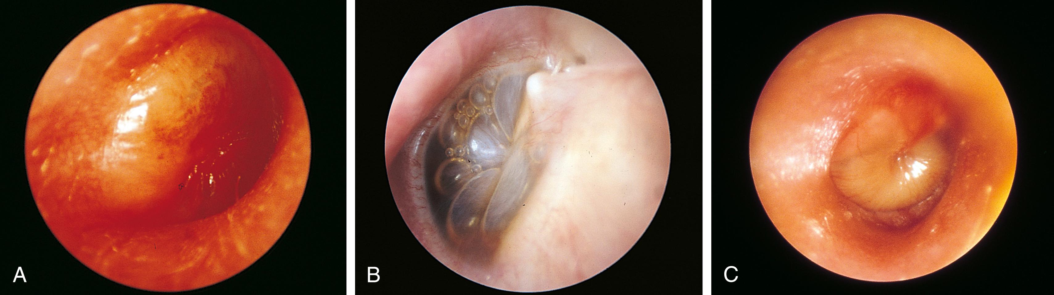 Fig. 24.24, Acute otitis media. (A) This is the textbook picture—an erythematous, opaque, bulging tympanic membrane. The light reflex is reduced, and the landmarks are partially obscured. Mobility is markedly reduced. (B) In this acutely febrile child who complained of otalgia, the presence of both air and fluid formed bubbles separated by grayish-yellow menisci. Even though the drum was not injected, this finding, combined with fever and otalgia, is consistent with acute infection. (C) In this child, the tympanic membrane was injected at the periphery, and a yellow purulent effusion caused the inferior portion to bulge outward. Mobility was markedly reduced.