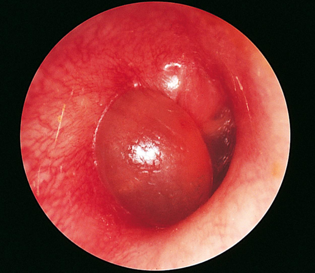 Fig. 24.25, Acute otitis media with bullous myringitis. This patient was febrile and extremely uncomfortable. On otoscopy, an erythematous bullous lesion is seen obscuring much of the tympanic membrane. This phenomenon, called bullous myringitis, is caused by the usual pathogens of otitis media in childhood. The bullous lesion often ruptures and drains spontaneously, providing immediate relief of pain.