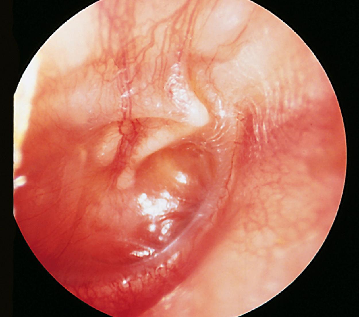 Fig. 24.27, Serous otitis media. This patient has a chronic serous middle ear effusion. The tympanic membrane is retracted, thickened, and shiny. Behind it is a clear yellow effusion. Mobility was decreased and primarily evident on negative pressure. The child was not acutely ill but did have decreased hearing.