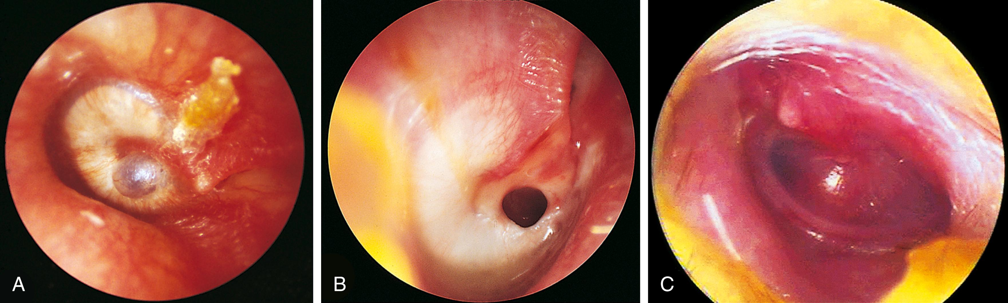 Fig. 24.28, Sequelae of chronic otitis media. (A) Much of this child’s tympanic membrane is scarred and thickened, and a thinned dimeric area balloons out of the inferior central portion. (B) The eardrum is markedly thickened, scarred in an arc from 12 to 5 o’clock, and has a large chronic perforation. (C) Severe retraction of the tympanic membrane is seen in this patient. The membrane adheres to the malleus.