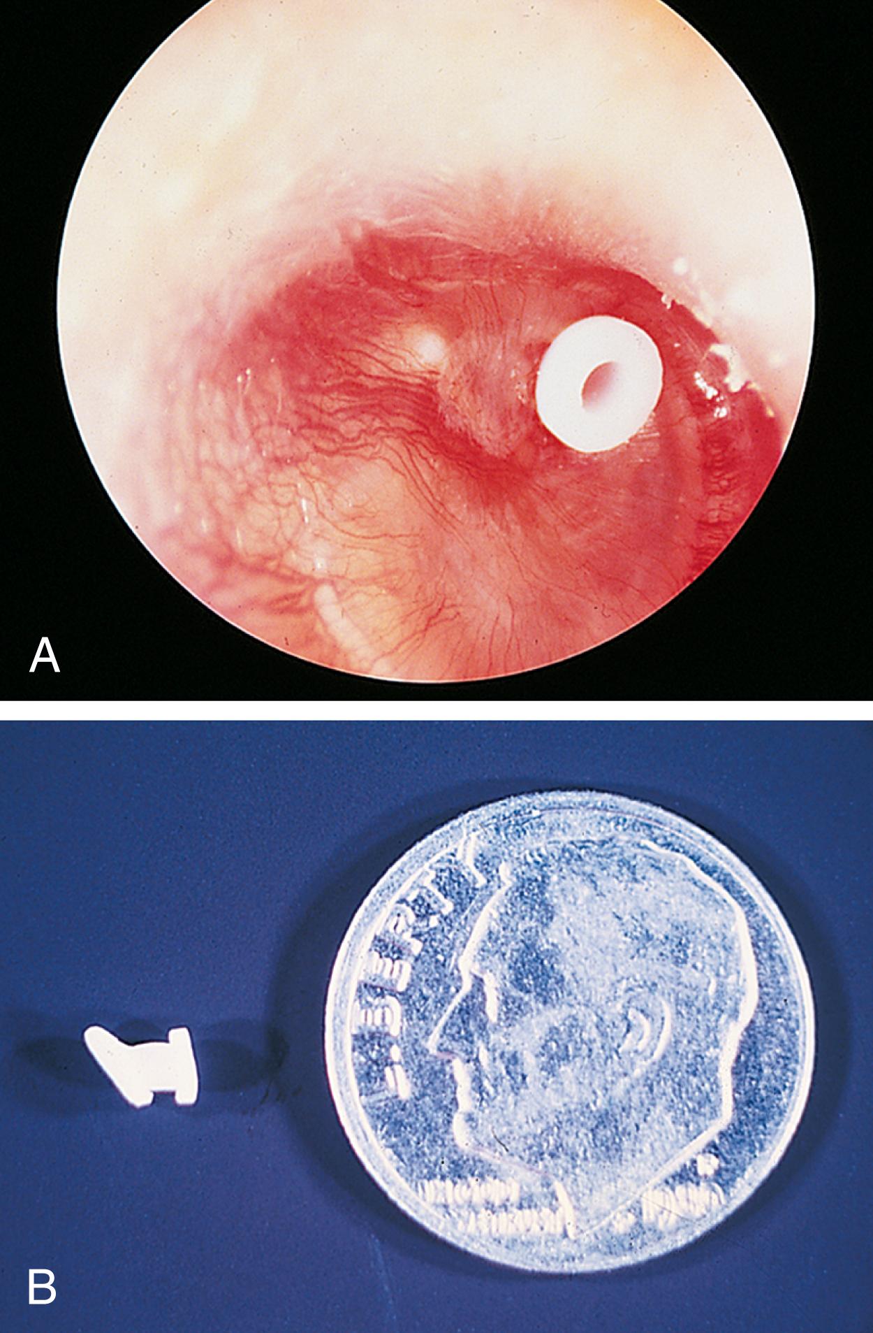 Fig. 24.29, (A) Tympanic membrane of patient with a history of chronic otitis media, with tympanostomy tube in place. The tube serves to vent the middle ear, improve hearing, and reduce the frequency of infection. (B) The tympanic membrane is slightly smaller than the size of a dime. A typical tube takes up approximately 15% of the tympanic membrane’s surface area. There are many different types in a variety of shapes, materials, sizes, and colors. Selection is based on specific pathology and surgeon preference.