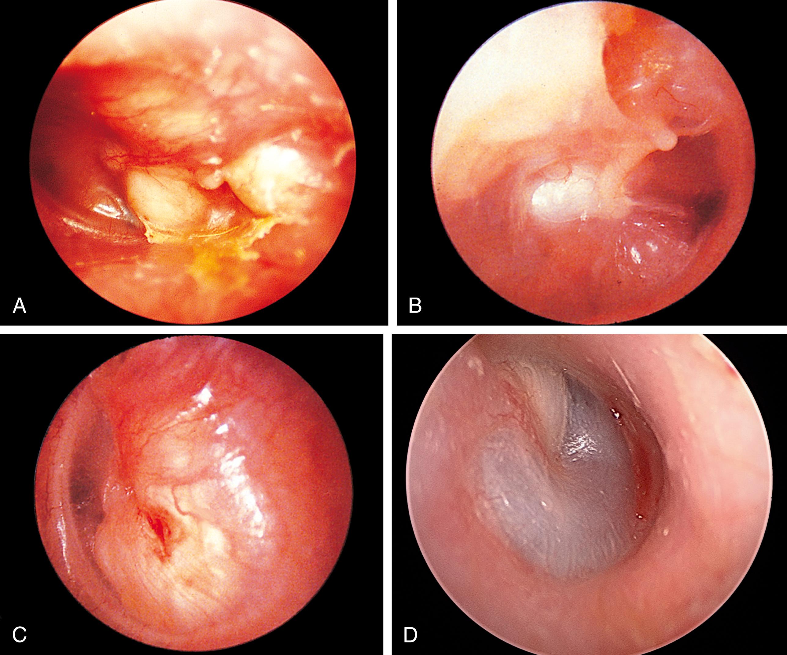 Fig. 24.30, Cholesteatomas. (A) Congenital cholesteatoma noted in a young child with spontaneous ear drainage. No previous history of ear infections existed. (B and C) Acquired cholesteatomas, which generally present after a long history of chronic middle ear disease. (D) Congenital cholesteatoma presenting as a right anterosuperior middle ear mass.