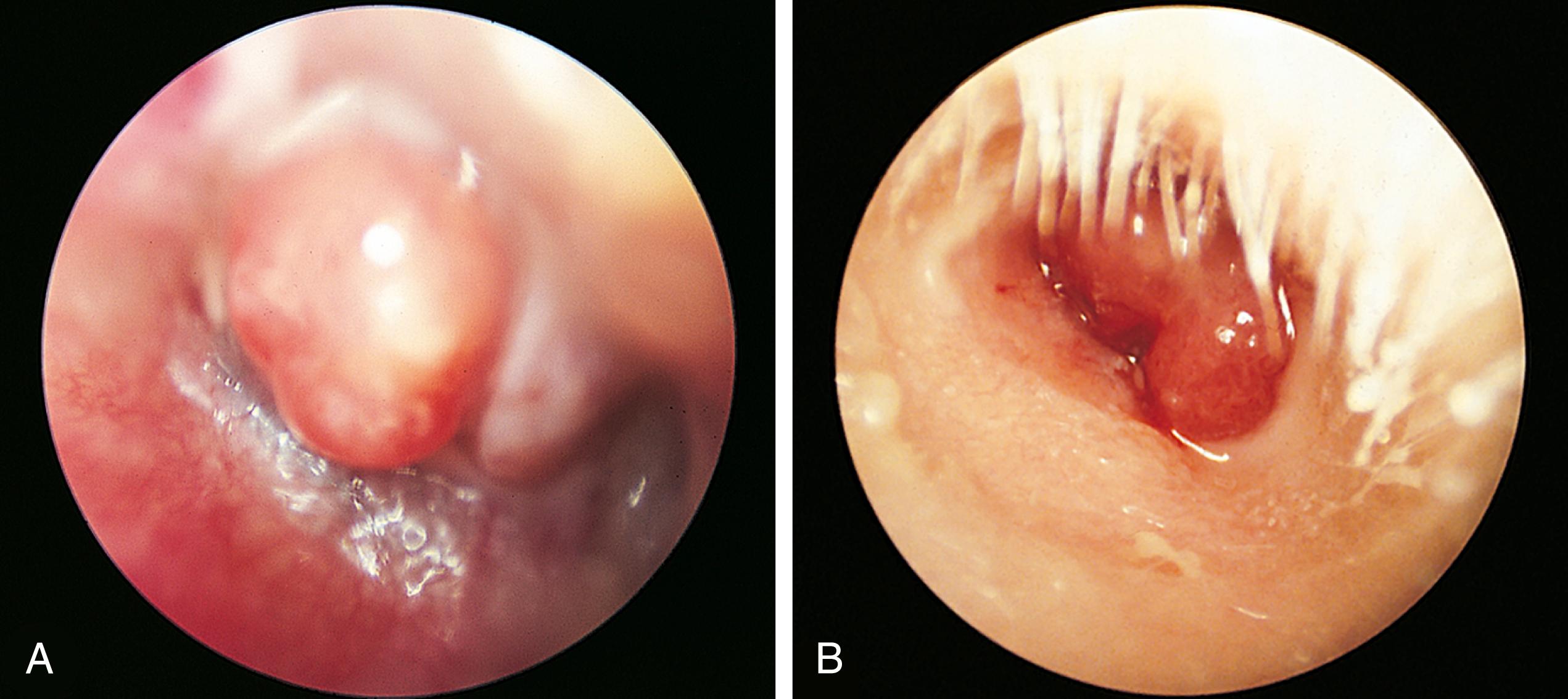 Fig. 24.31, Granulomas and polyps of the tympanic membrane. (A) Growth of this polypoid granuloma was stimulated by the inflammatory process of chronic middle ear infection. (B) These polyps, which protrude through a tympanic membrane perforation, have enlarged to entirely fill the external ear canal. Because of the possible attachment of the polyp to the facial nerve or the ossicles of the middle ear, removal of polyps requires extreme caution.