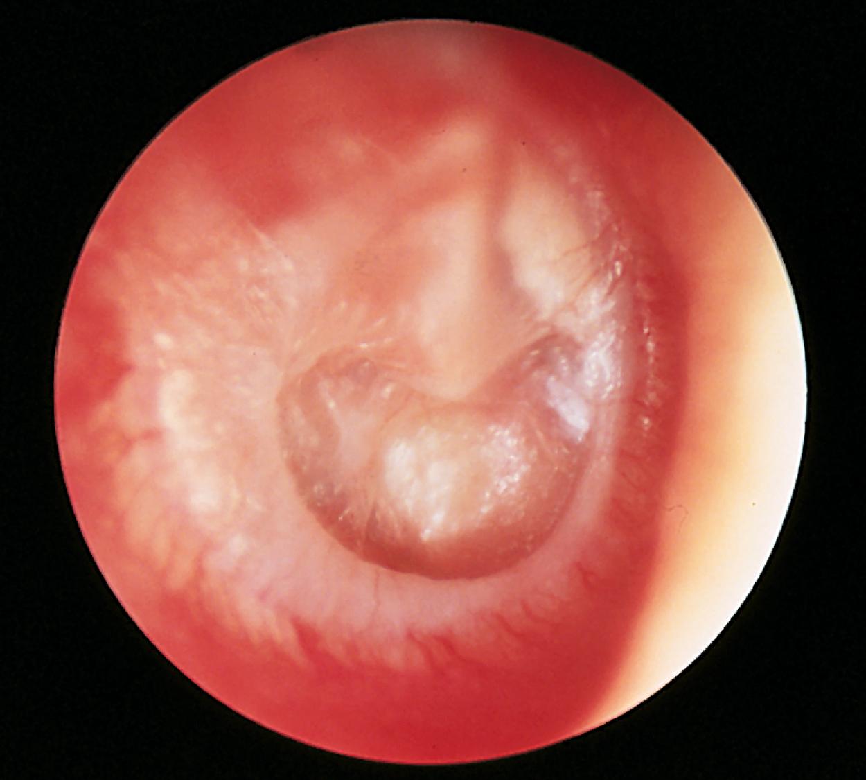 Fig. 24.32, Dimerism of the tympanic membrane. Otoscopy demonstrates a severely retracted atrophic segment of the eardrum that also has multiple white scars (tympanosclerosis). The thinned portions are the result of abnormal healing of perforations and tend to be hypermobile on otoscopy.