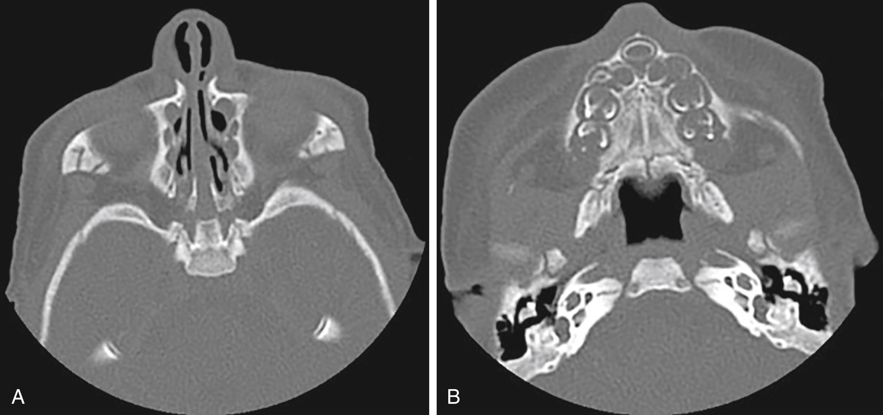 Fig. 24.34, Pyriform aperture stenosis (PAS). A pyriform aperture measuring <11 mm on radiographic imaging is diagnostic for PAS. (A) Noncontrasted axis Computed tomography (CT) scan showing a pyriform aperture <11 mm and mid-nasal stenosis. (B) Noncontrasted axis CT scan showing a central medial incisor. Pituitary anomalies and holoprosencephaly may also be present.