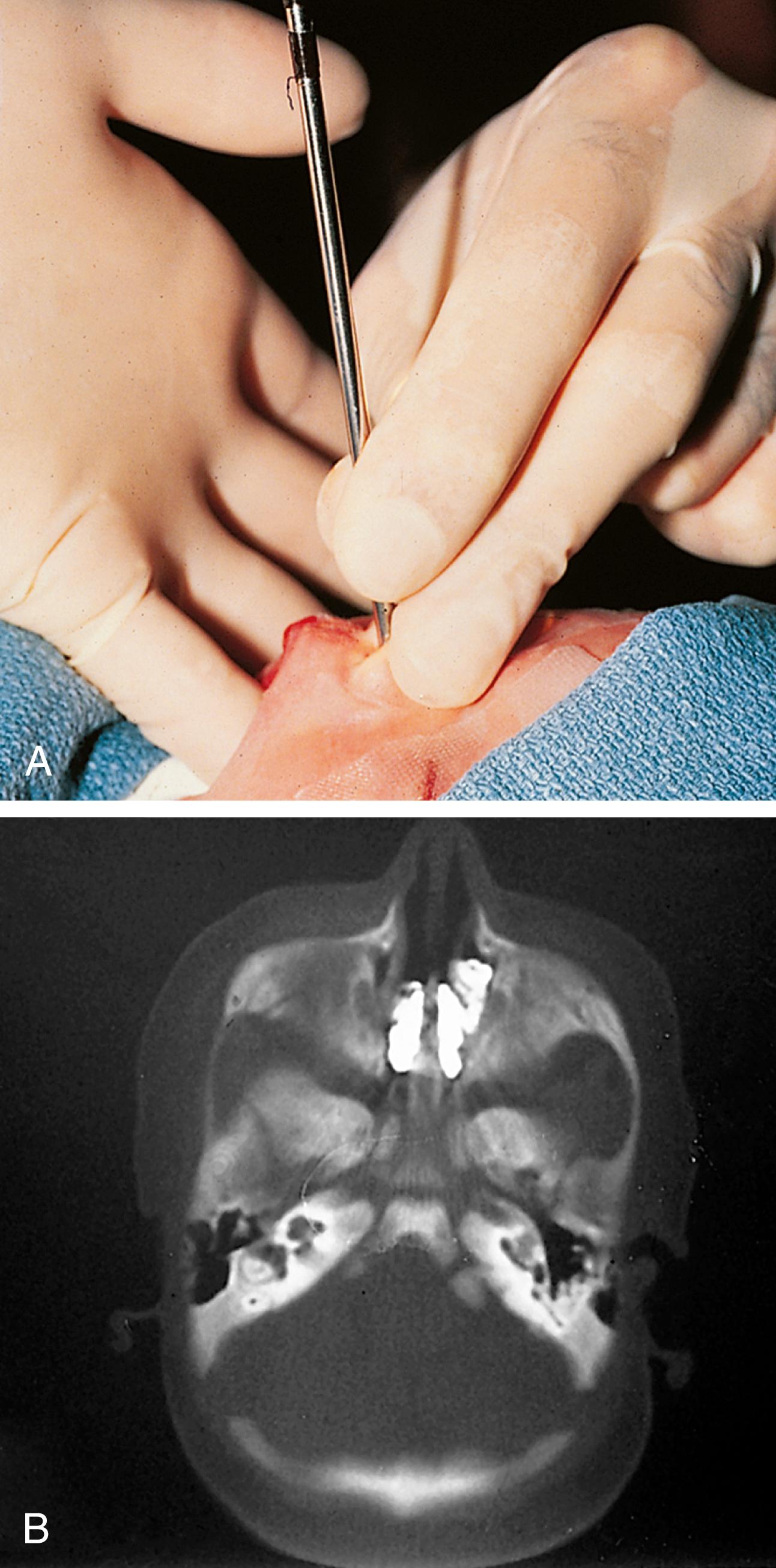 Fig. 24.35, Choanal atresia. (A) This infant manifested severe respiratory distress at delivery, with paradoxic cyanosis. Attempts to pass a urethral sound suggested bony obstruction of the choanae bilaterally. (B) A computed tomography (CT) scan done after instillation of radiopaque dye reveals pooling of the dye within the nose anterior to the choanae, confirming complete obstruction.