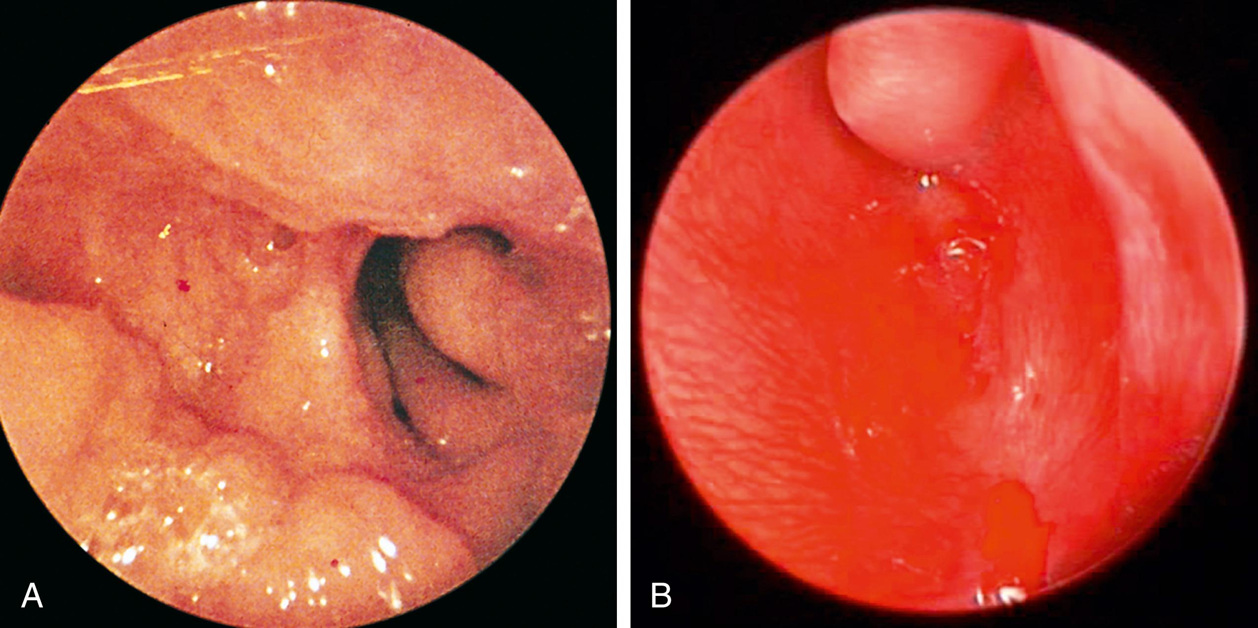 Fig. 24.36, Unilateral choanal atresia. (A) View of the nasopharynx using a 70-degree telescope in the oropharynx; the left choana is clearly patent, whereas the right is atretic. The child had a history of unilateral nasal discharge. (B) Left nasal endoscopy with a 0-degree telescope shows atresia.