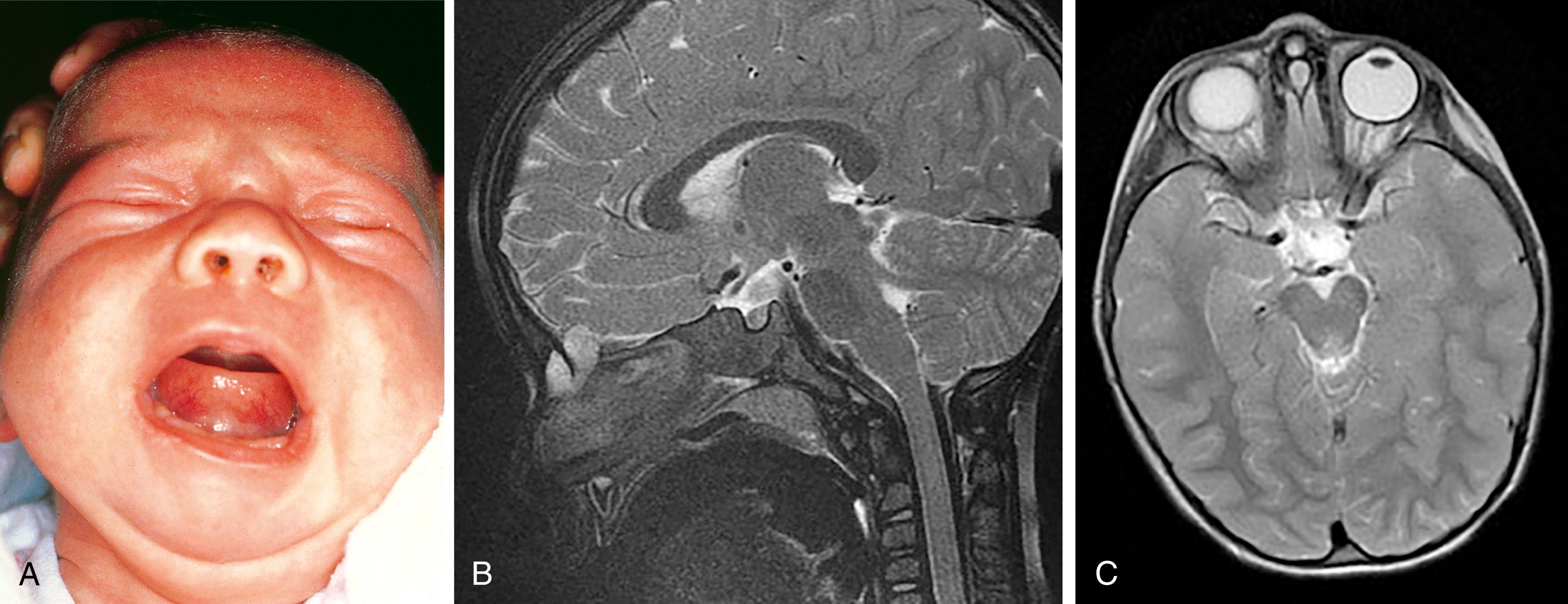 Fig. 24.38, Nasal dermoid. (A) A firm, round mass with a central dimple is seen over the bridge of this infant’s nose. (B) Sagittal T2 magnetic resonance imaging (MRI) demonstrates a heterogenous lesion extending through patent foramen caecum and fonticulus frontalis. (C) Axial T2 MRI of the same lesion.