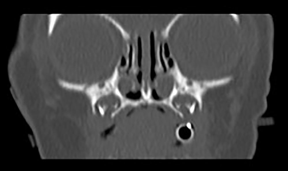 Fig. 24.39, Nasolacrimal duct cysts. Noncontrasted coronial computed tomography (CT) scan showing bilateral nasolacrimal duct cysts or dactroceles.