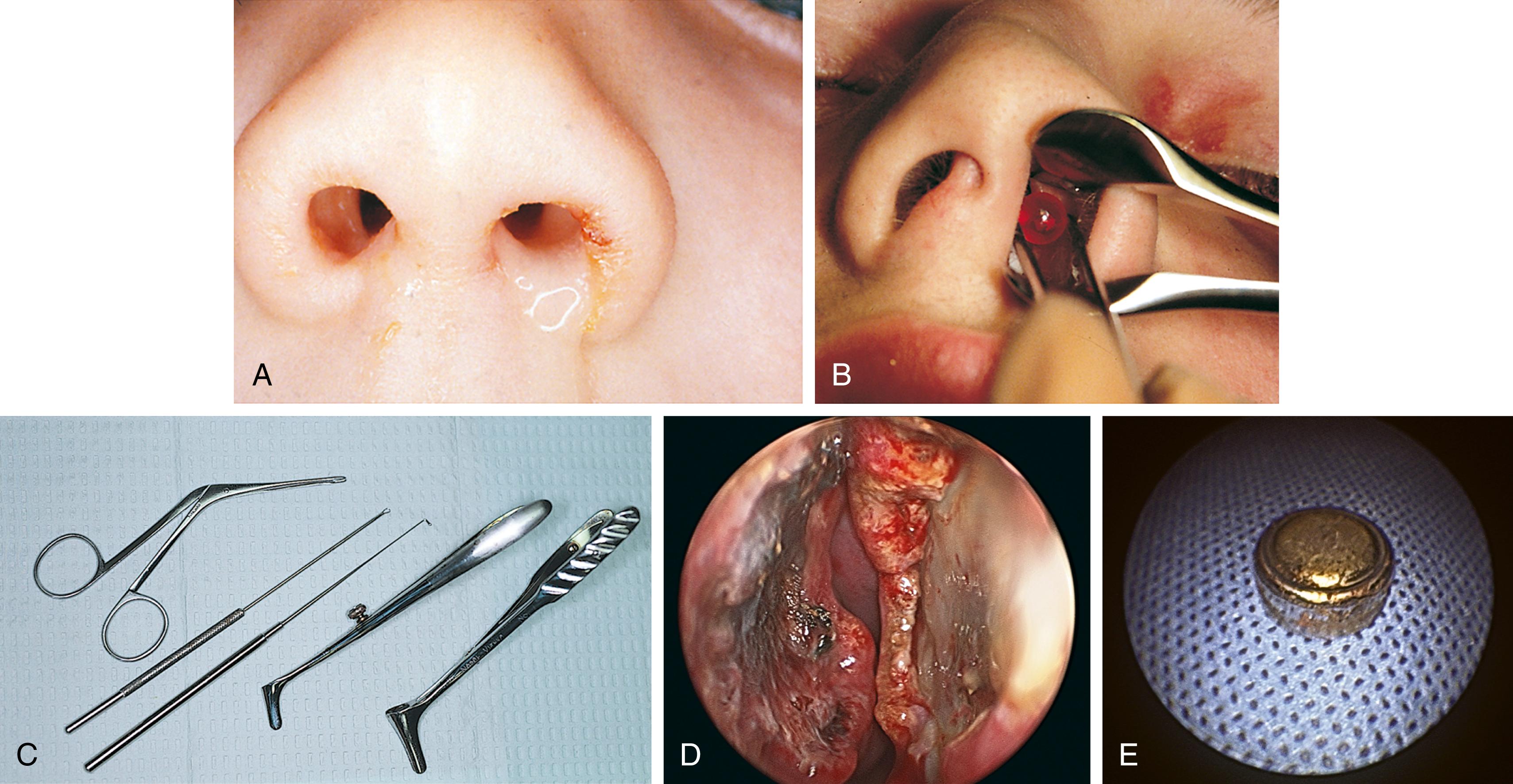 Fig. 24.41, Nasal foreign body. (A) This child had a unilateral, foul-smelling nasal discharge. (B) Aspiration of the discharge in this patient revealed a red bead that was removed with a Day hook. (C) Hartmann forceps, a small wire loop curette, and a right-angle Day hook are the instruments used most commonly for removal of nasal foreign bodies. Nasal spreaders assist visualization and create a wider space for inserting the desired instrument. Note that bleeding or aspiration of the nasal foreign body may occur, especially with uncooperative toddlers. Thus consideration should be given for removal of nasal foreign bodies in the operating room with general anesthesia and a controlled airway. (D) Severe intranasal damage resulting from a nasal foreign body—a tiny watch battery. (E) The watch battery removed.