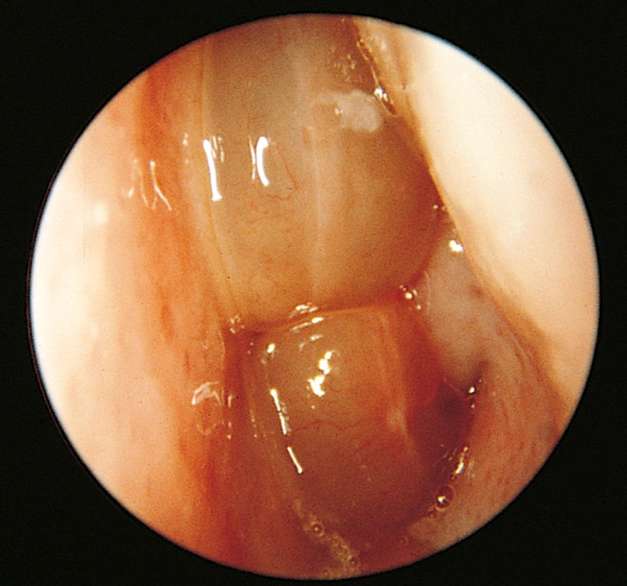 Fig. 24.42, Nasal polyp. This 2-year-old girl with cystic fibrosis was referred because of nasal obstruction and nocturnal snoring of a few months’ duration. A large grayish polyp was found in the left nostril. Any child presenting with a nasal polyp should be tested for cystic fibrosis.