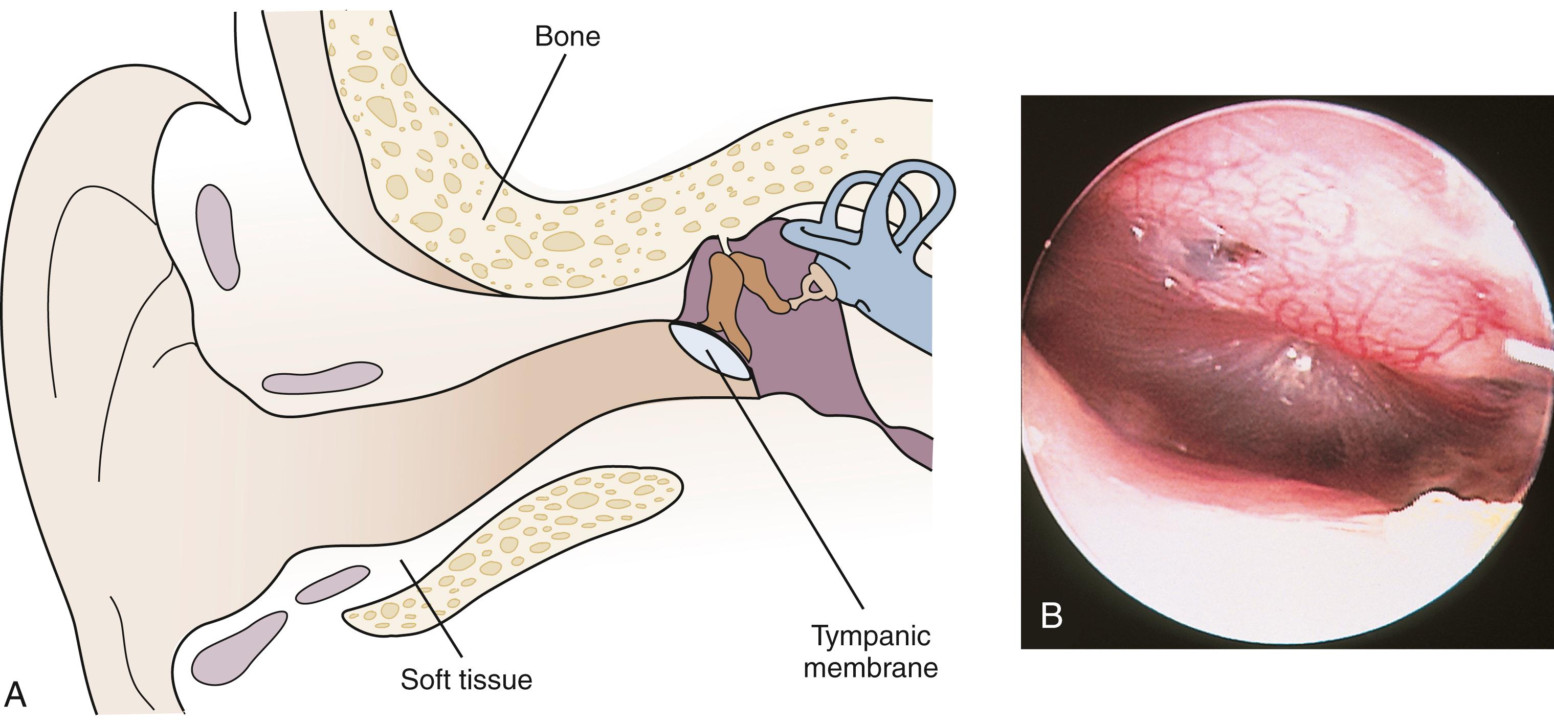 Fig. 24.6, Angulation of the tympanic membrane in infancy. (A) The relationship between the ear canal and eardrum is different in the infant, with the drum being tilted at an angle of 130 degrees. (B) Greater care is required in examining an infant’s eardrum because of this angulation and because the landmarks are less prominent.