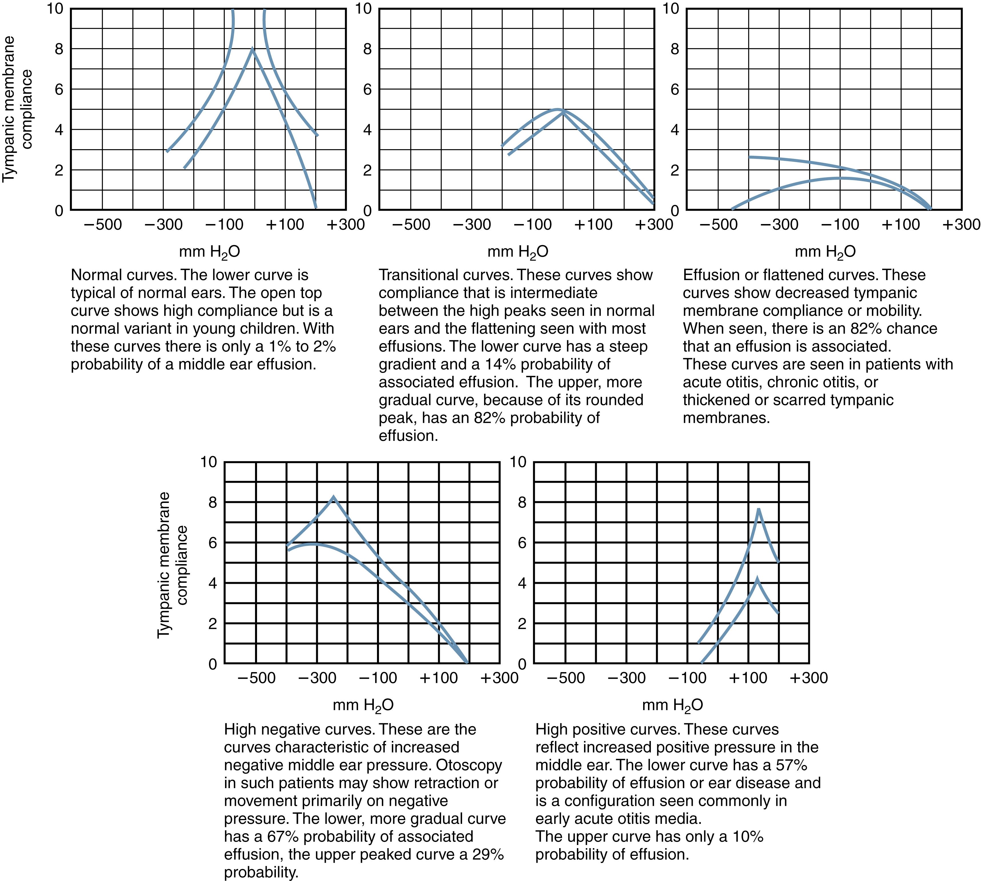 Fig. 24.7, Tympanometric patterns of various conditions of the middle ear.