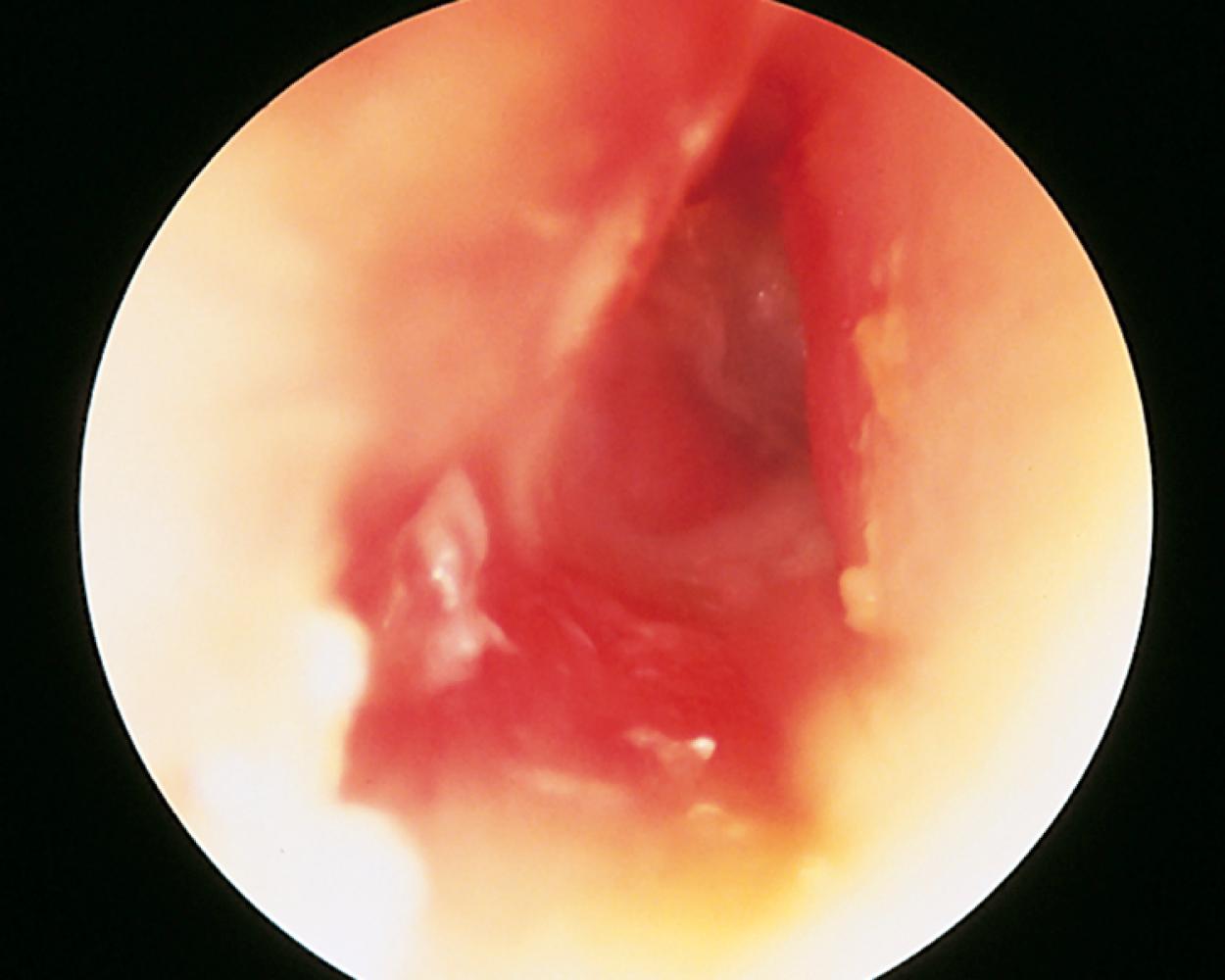 Fig. 24.9, External otitis. Acute bacterial external otitis is characterized by intense pain that is worsened by traction on the pinna, along with purulent exudate and intense canal wall inflammation with normal tympanic membrane mobility on pneumatic otoscopy.