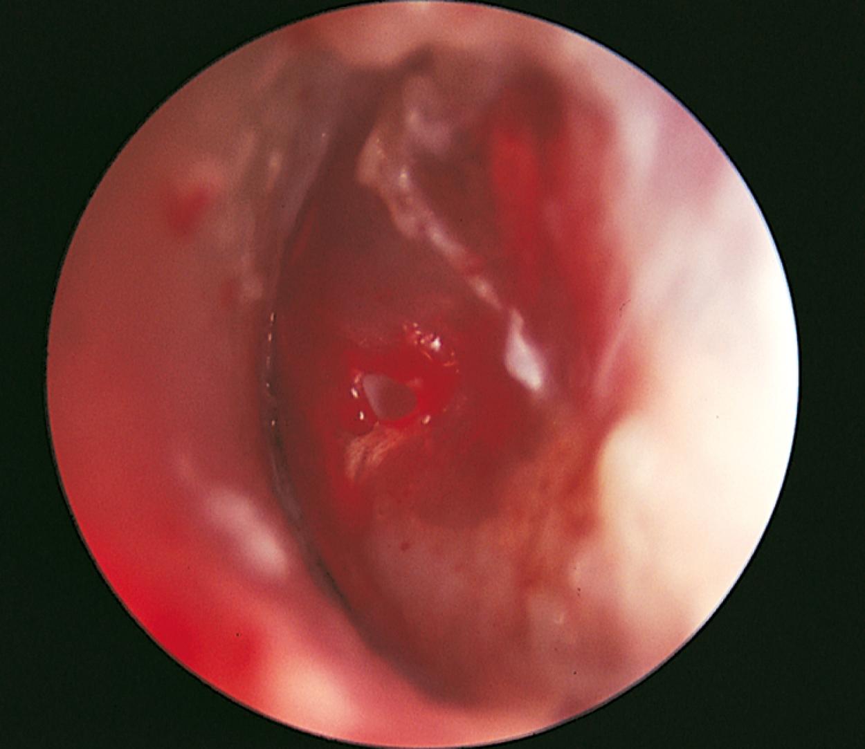 Fig. 24.26, Acute otitis media with perforation. In this child, increased middle ear pressure with acute otitis resulted in perforation of the tympanic membrane. The drum is thickened, and the perforation is seen at the 9 o’clock position.